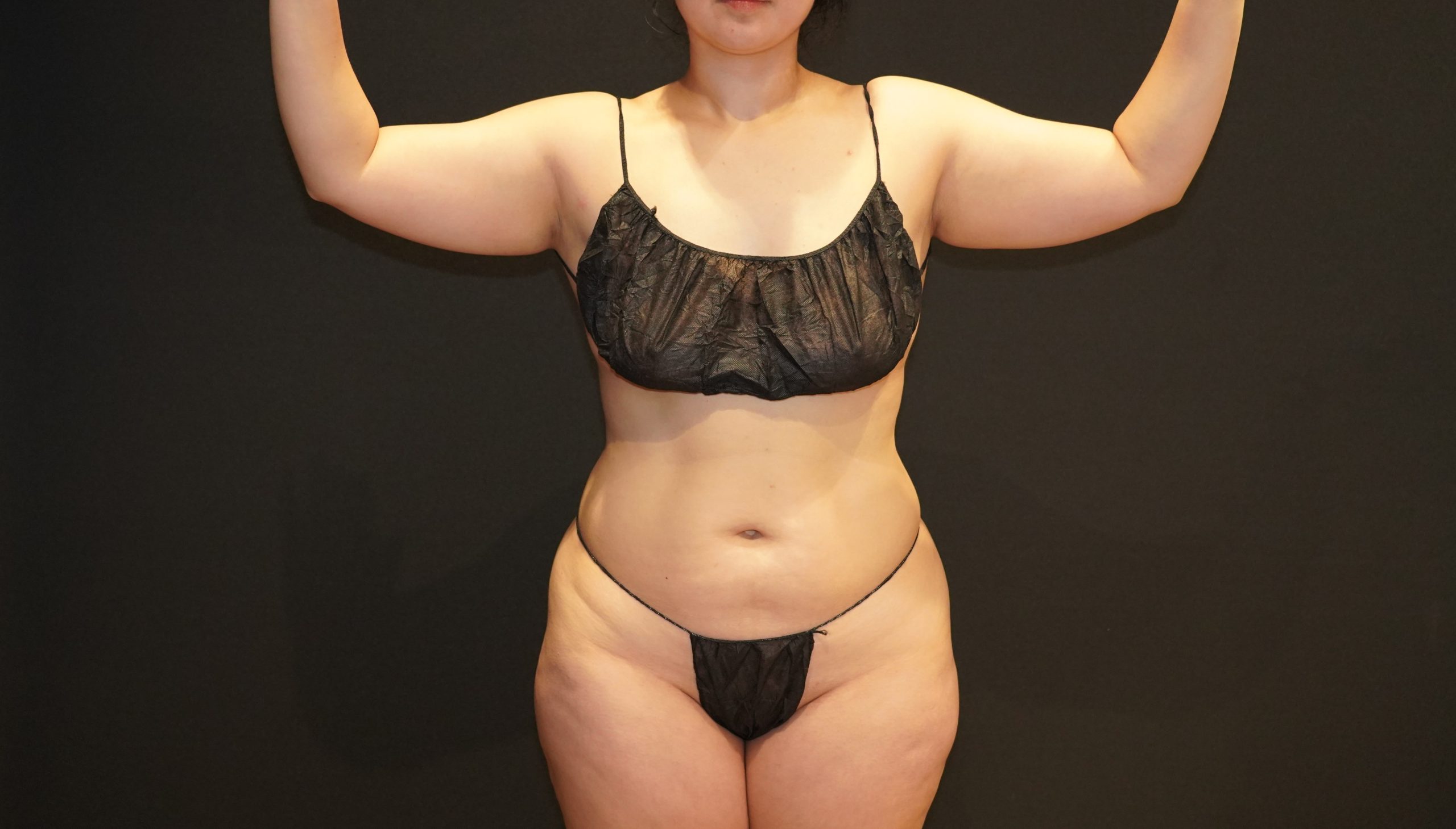 Case--4597 | Before Body Liposuction & Contouring