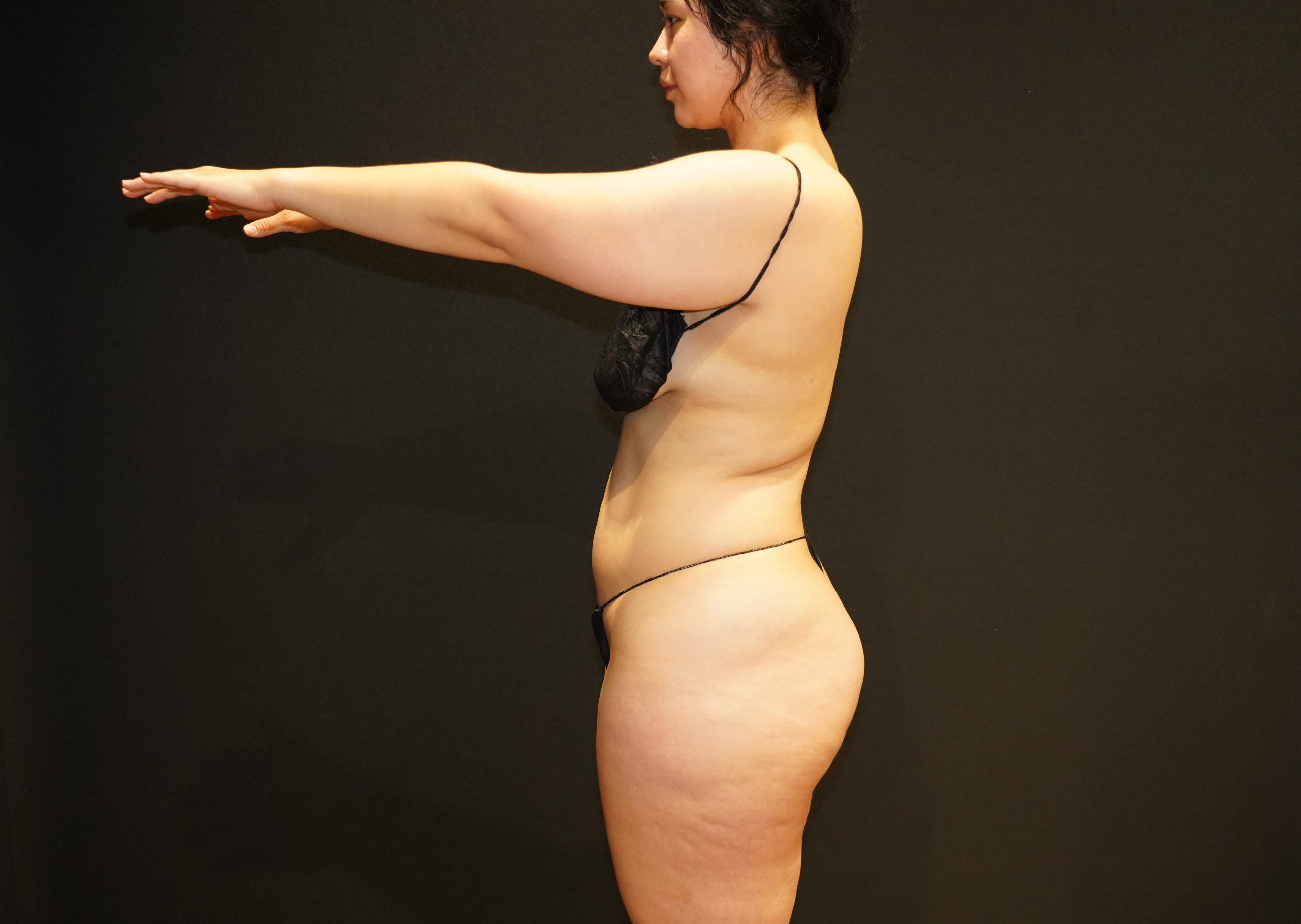 Case--4597 | Before Body Liposuction & Contouring 4