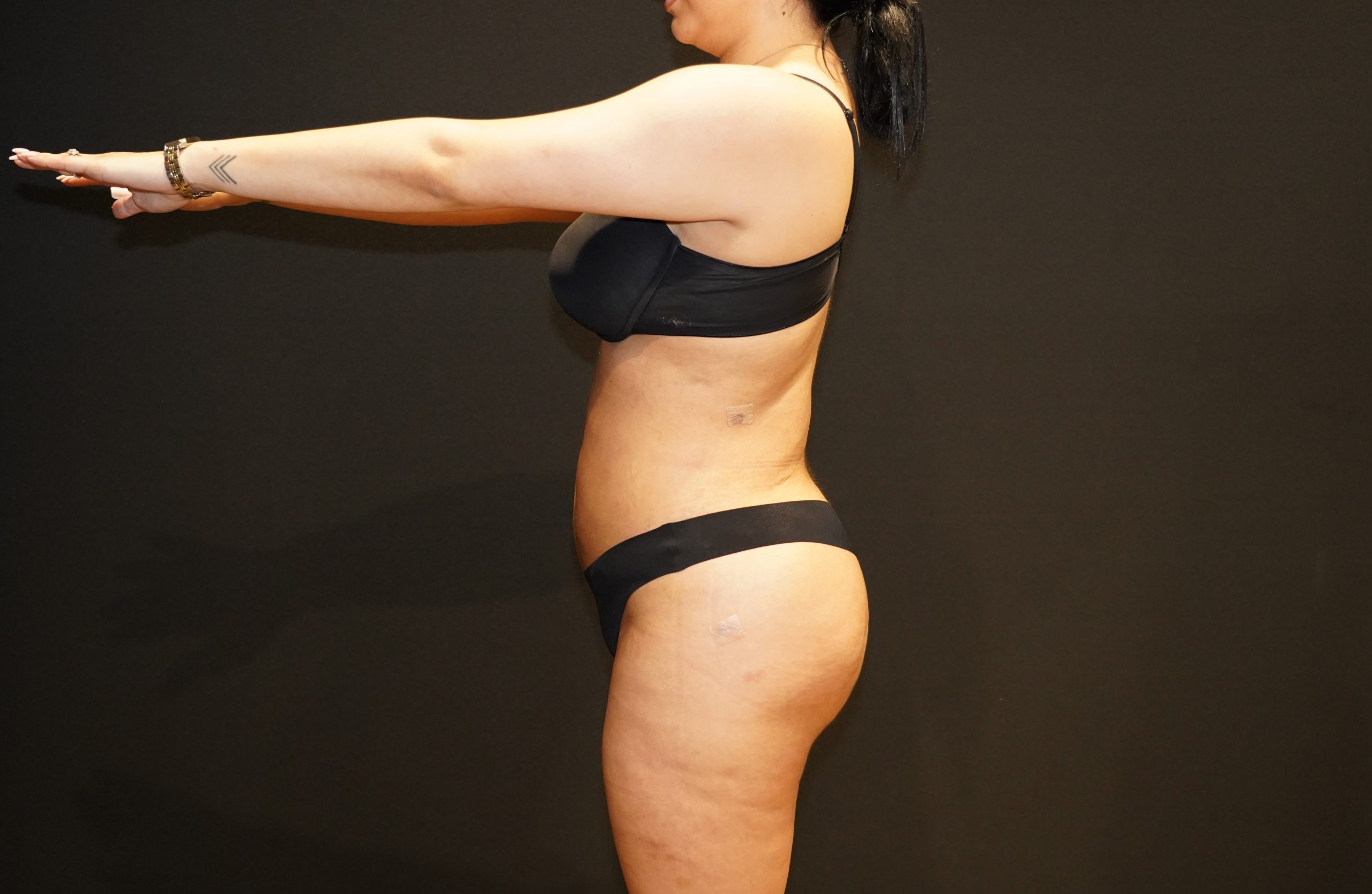 Case--2148 | After Brazilian Butt Lift 4