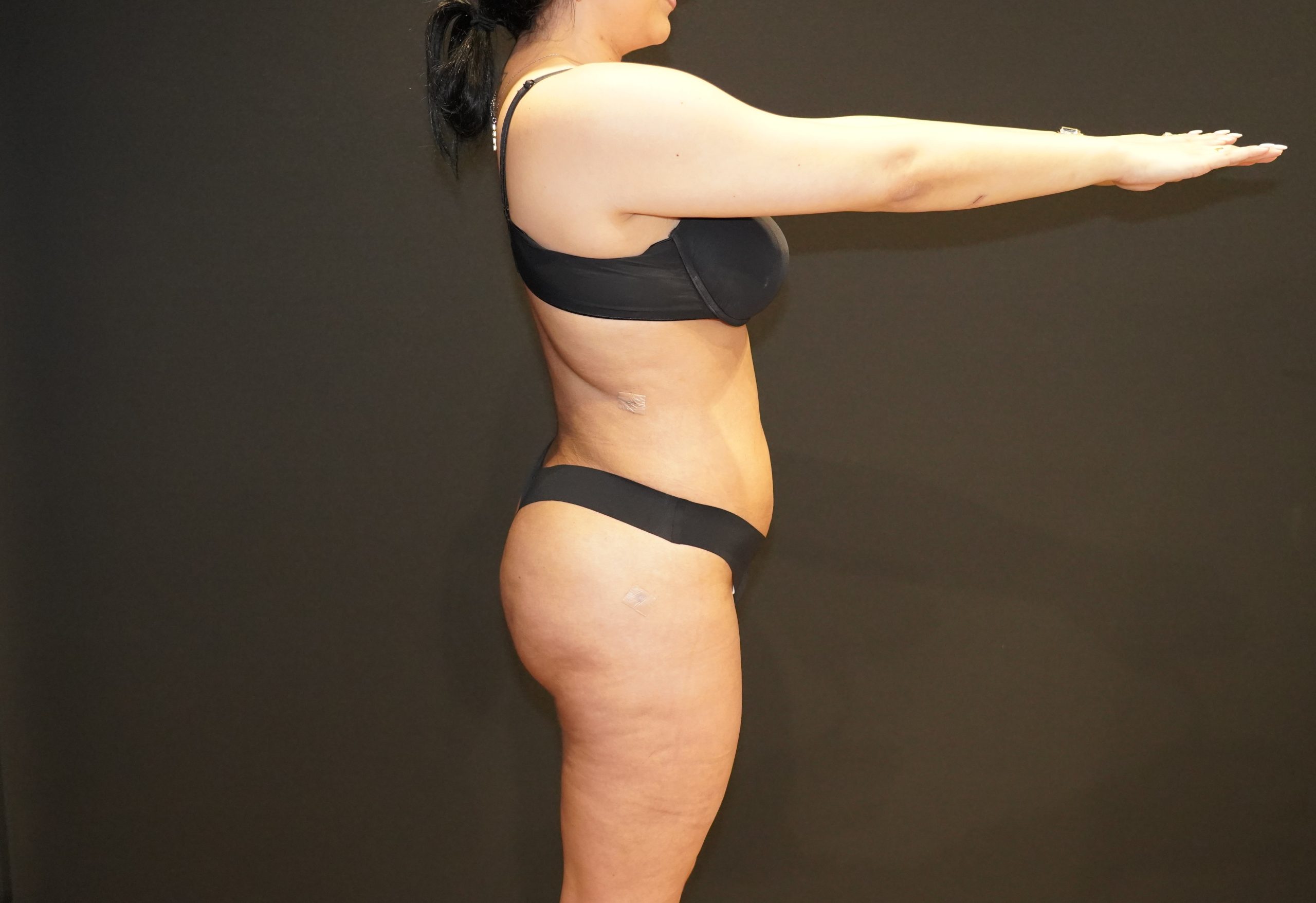 Case--2148 | After Brazilian Butt Lift 3