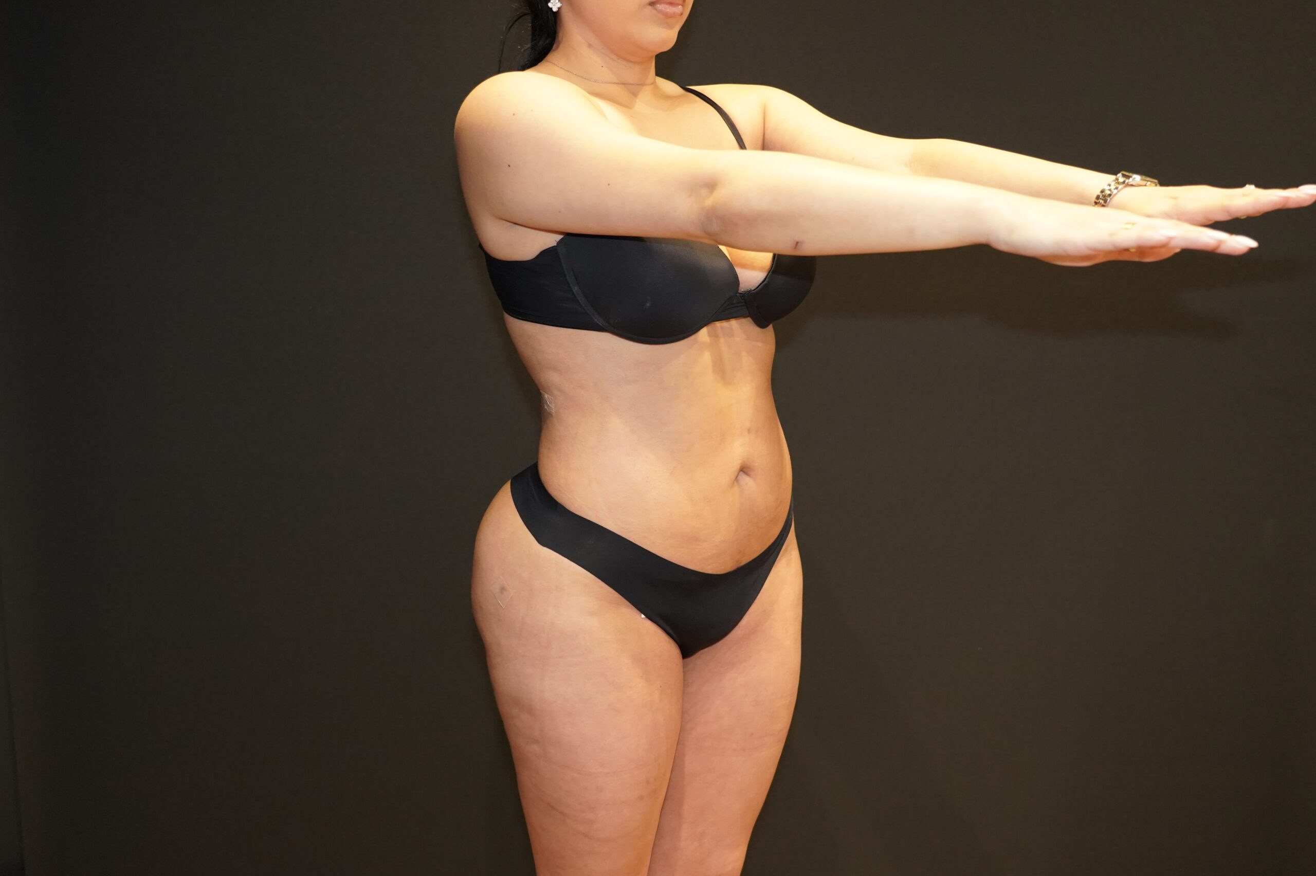 Case--7681 | After Body Liposuction & Contouring 3
