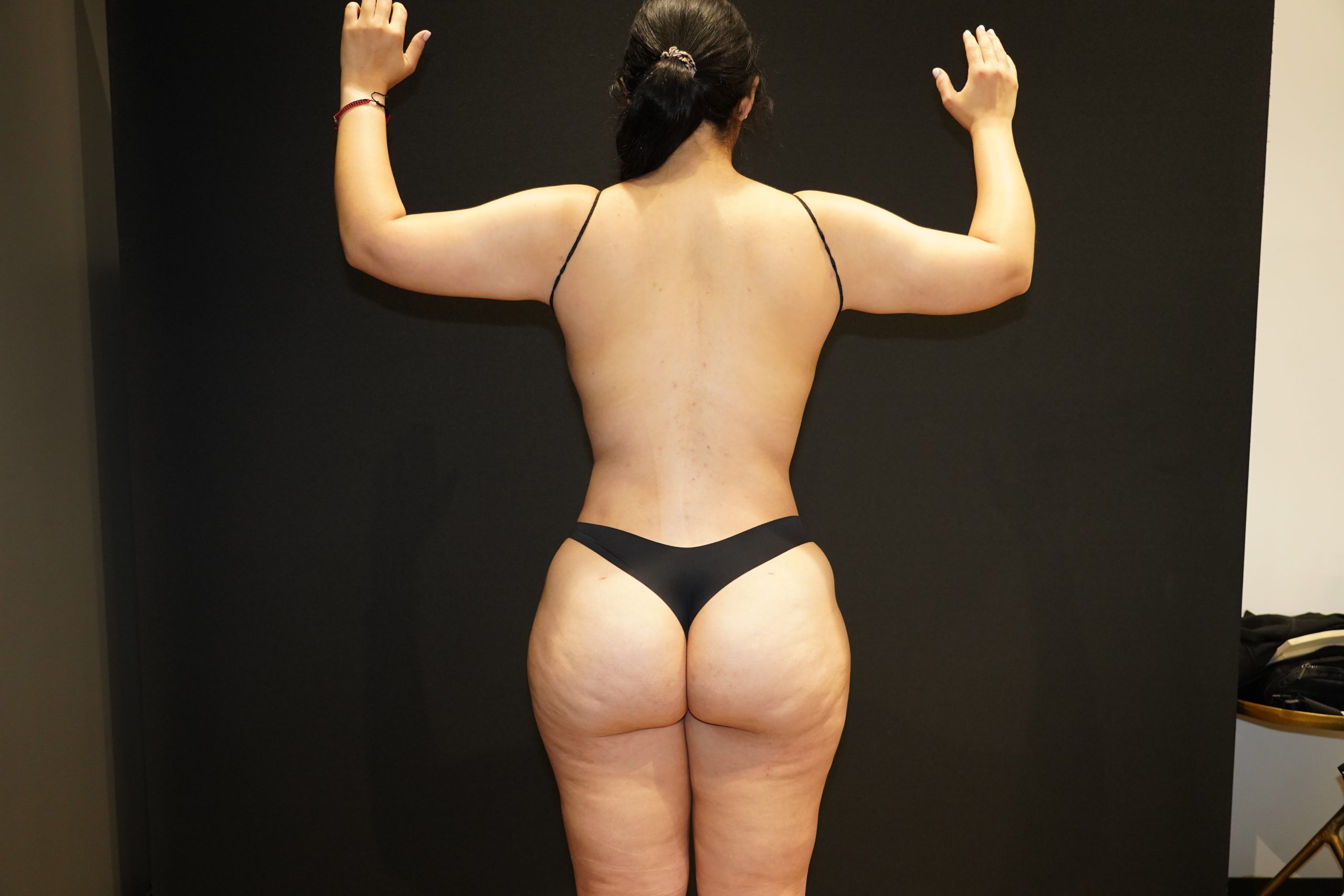 Case--4597 | After Body Liposuction & Contouring 2