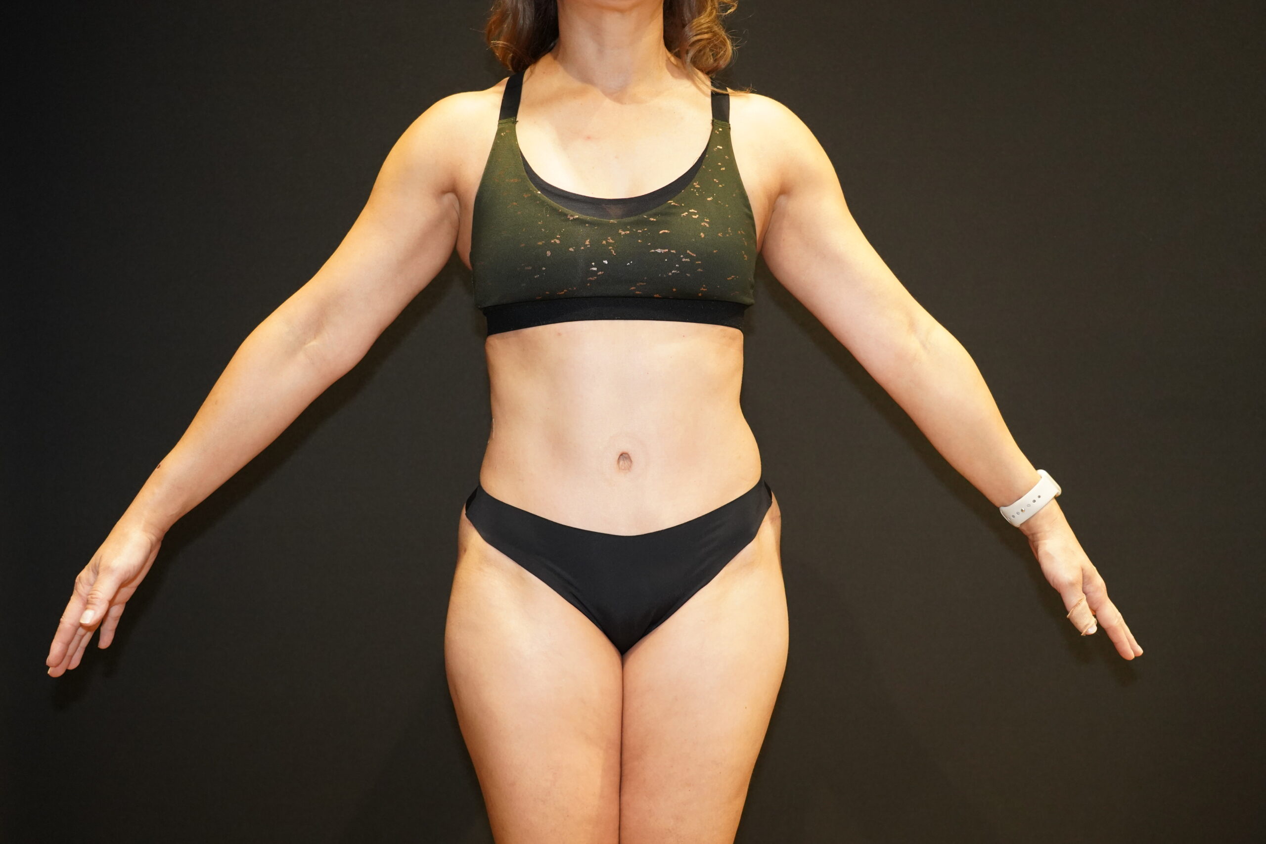Case--4185 | After Tummy Tuck 3