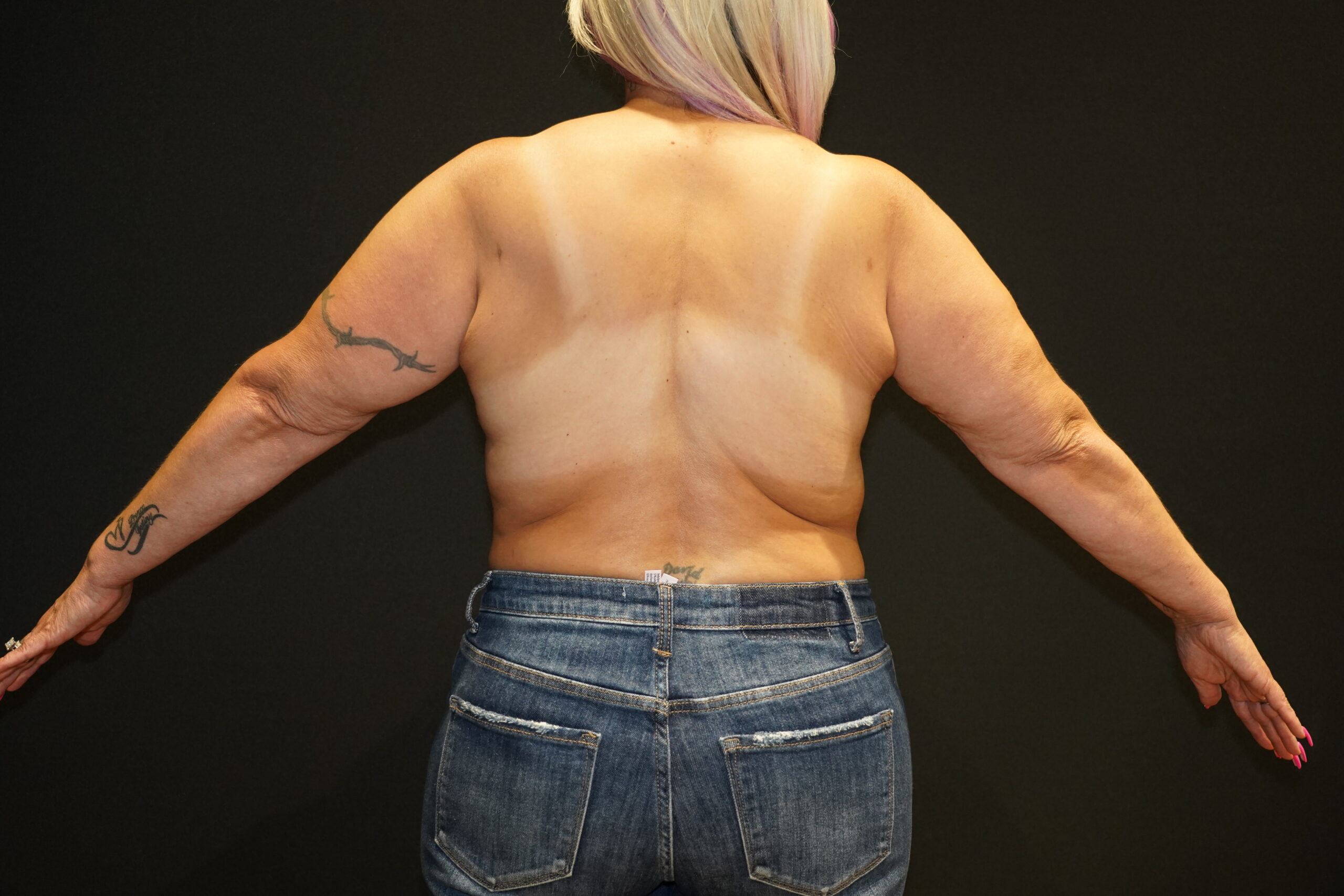 Case--9550 | After Breast Lift/Mastopexy 5