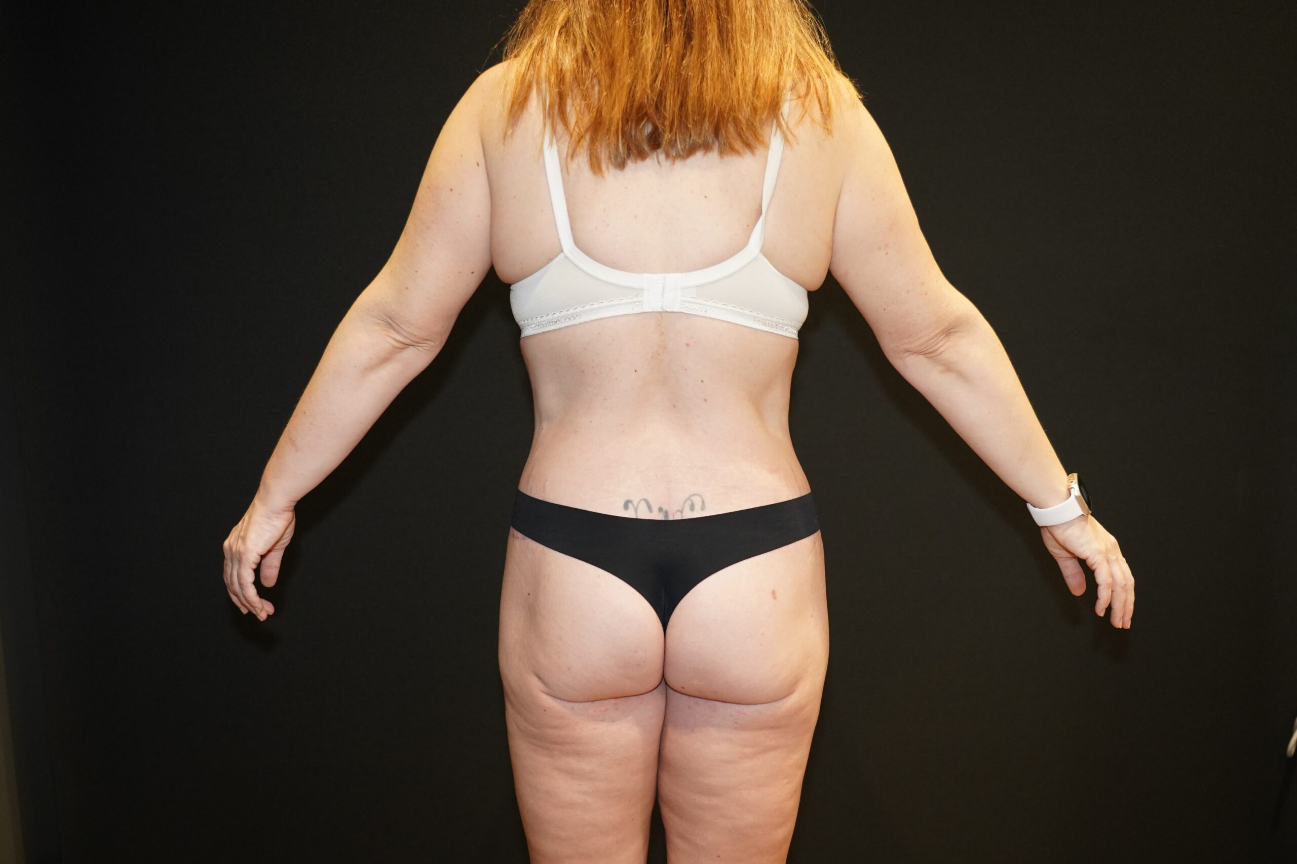 Case--6546 | After Body Procedures