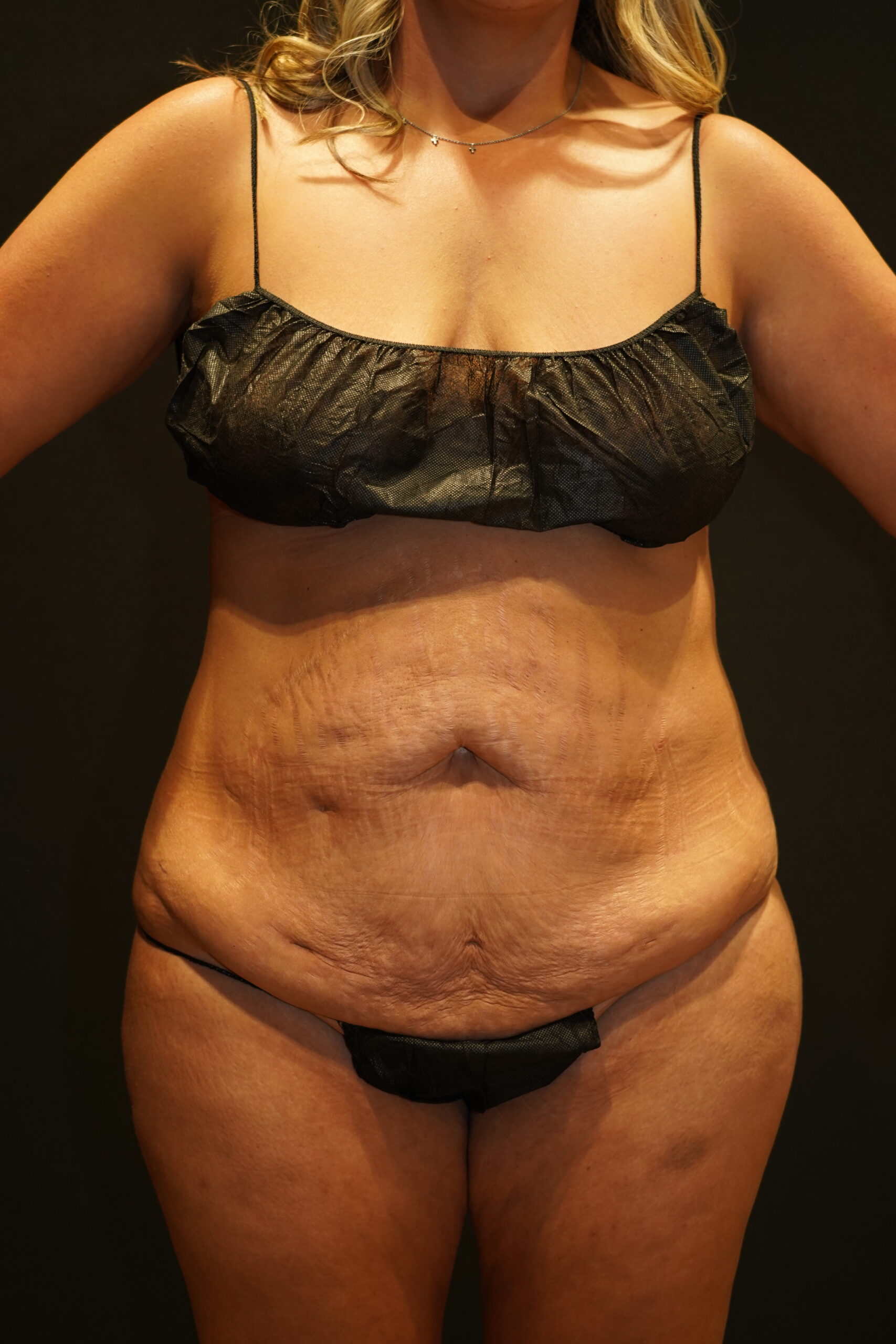 Before photo - 0° view