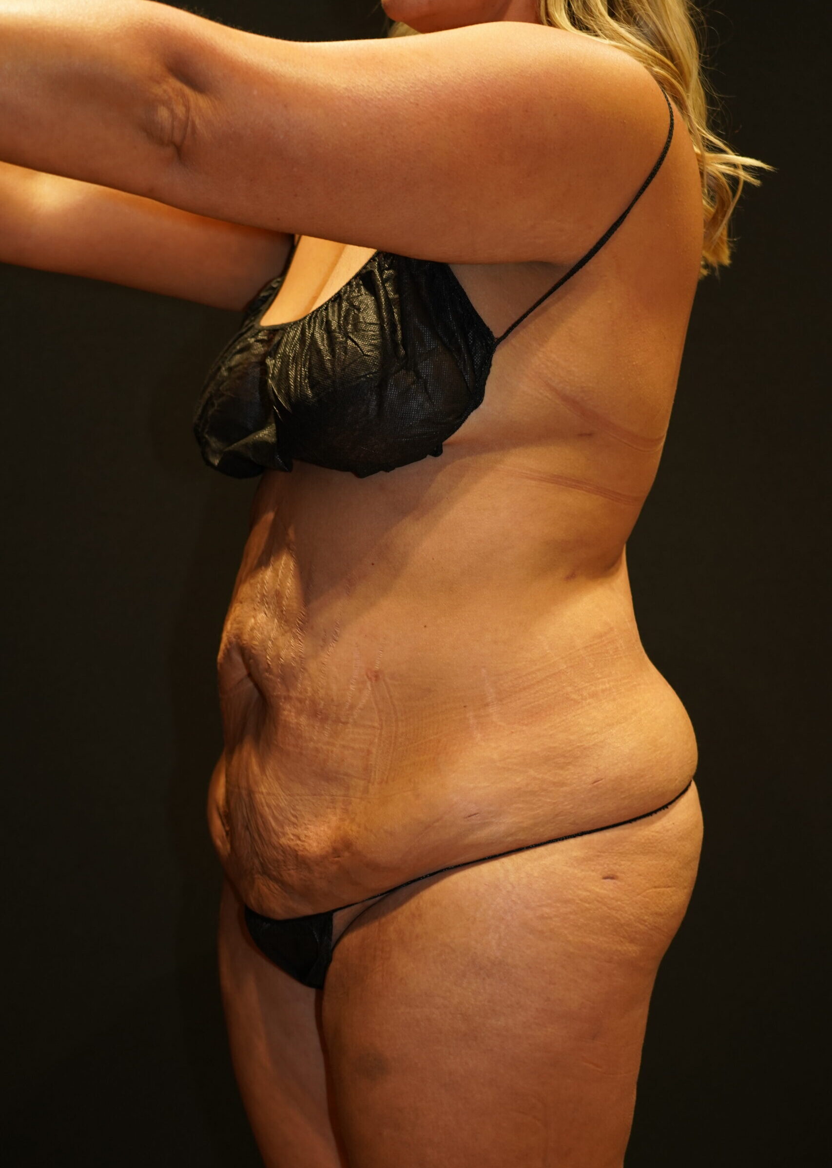 Before photo - -45° view