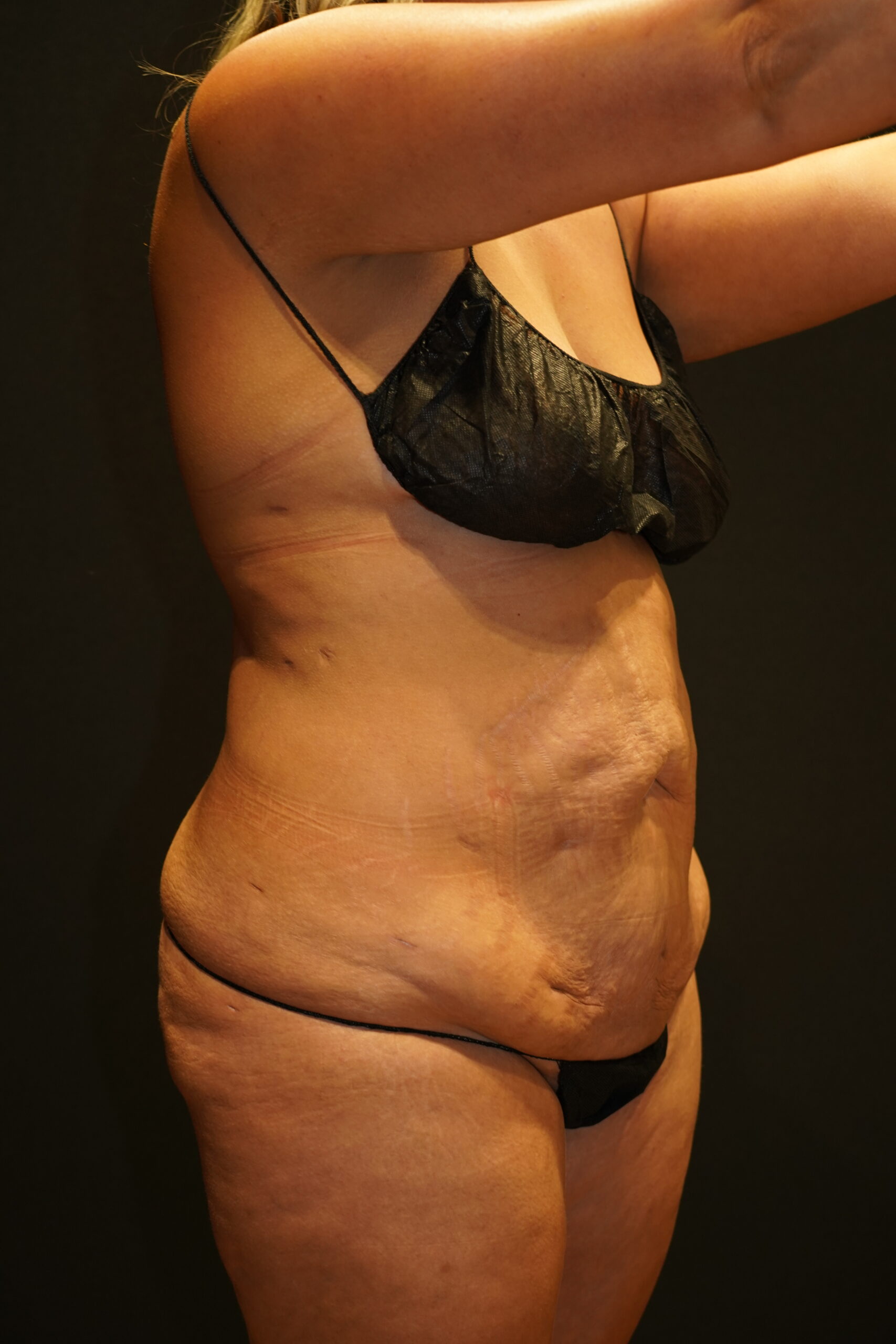 Before photo - 45° view