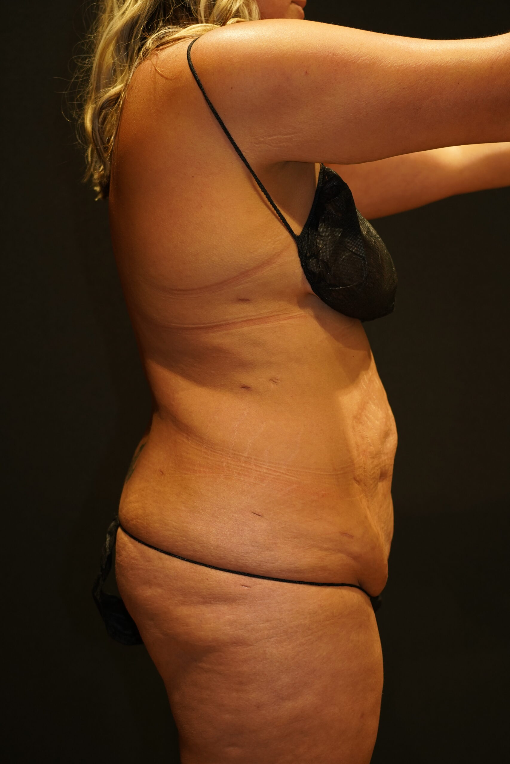 Before photo - 90° view