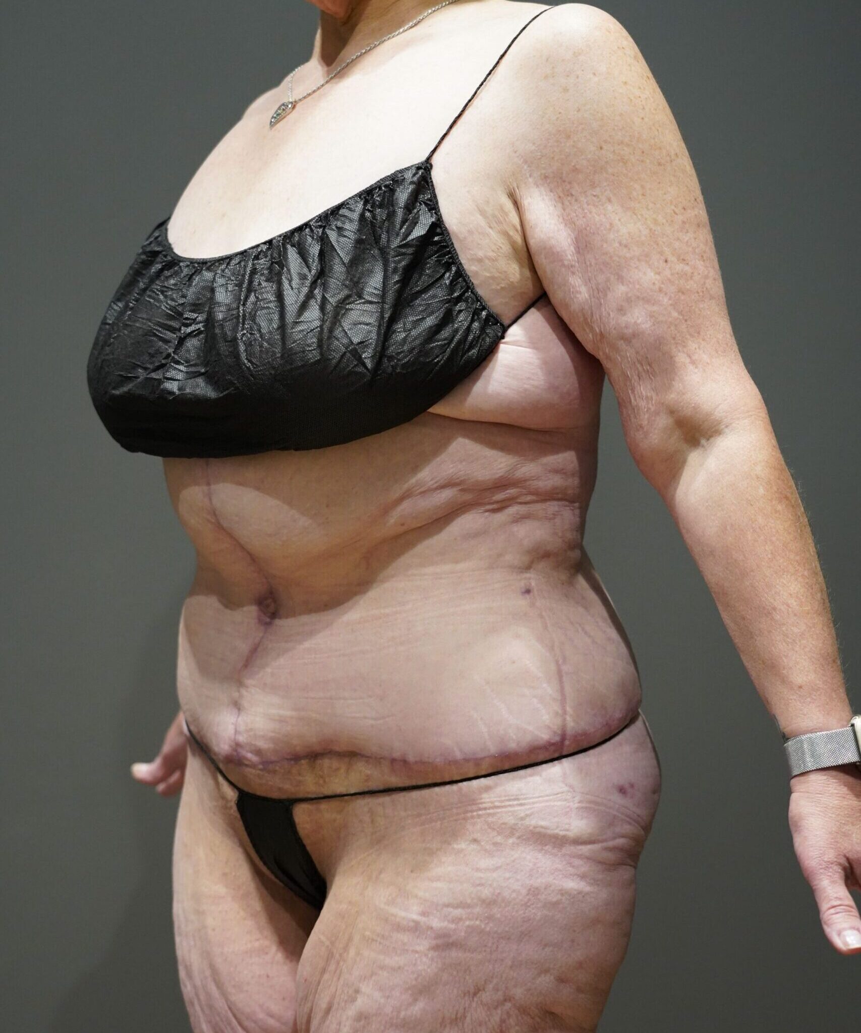 After photo - -45° view