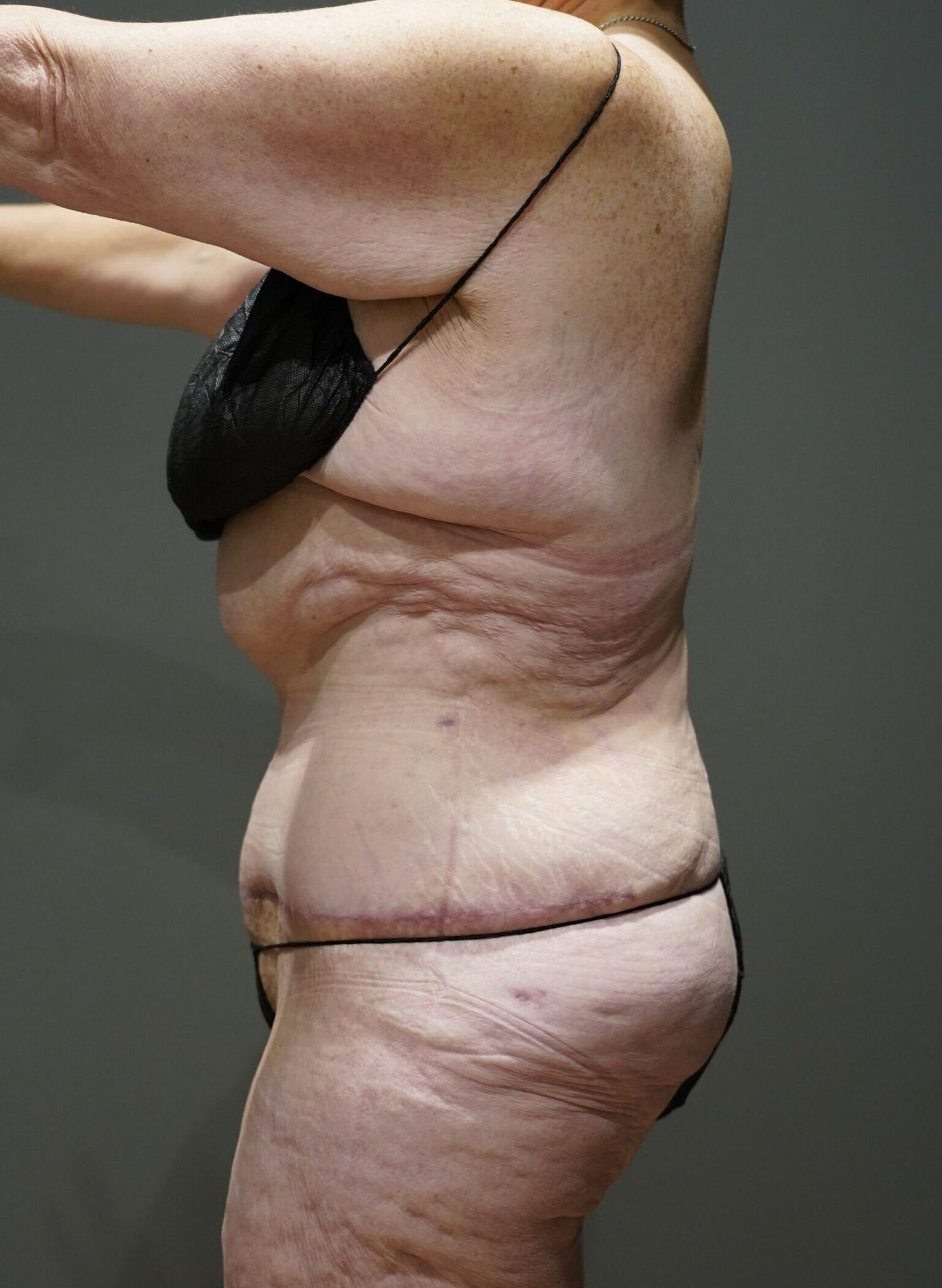 After photo - -90° view