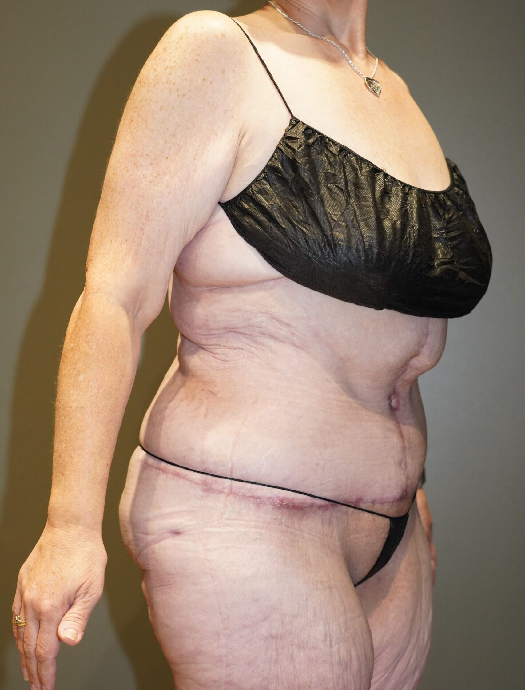 After photo - 45° view