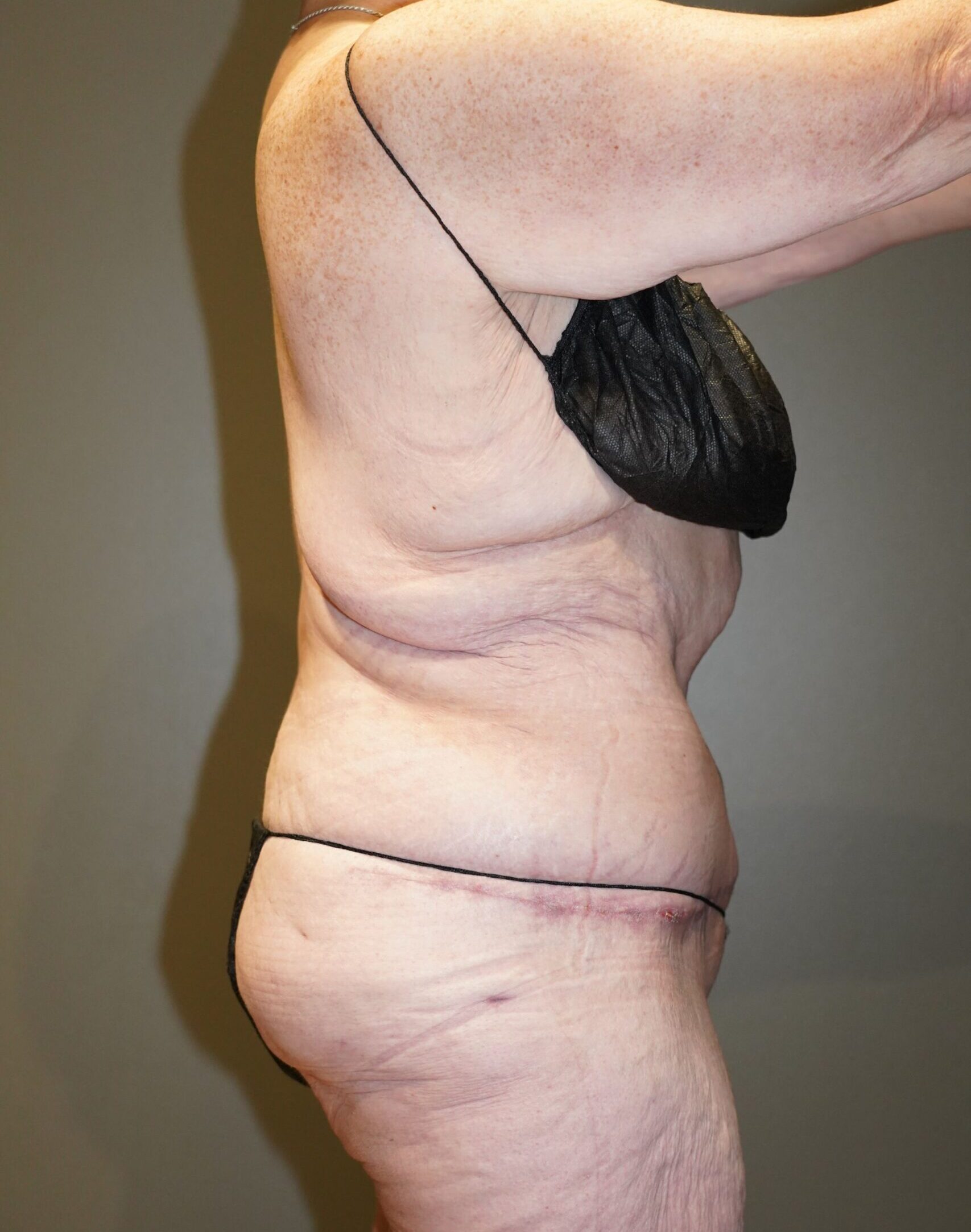 After photo - 90° view