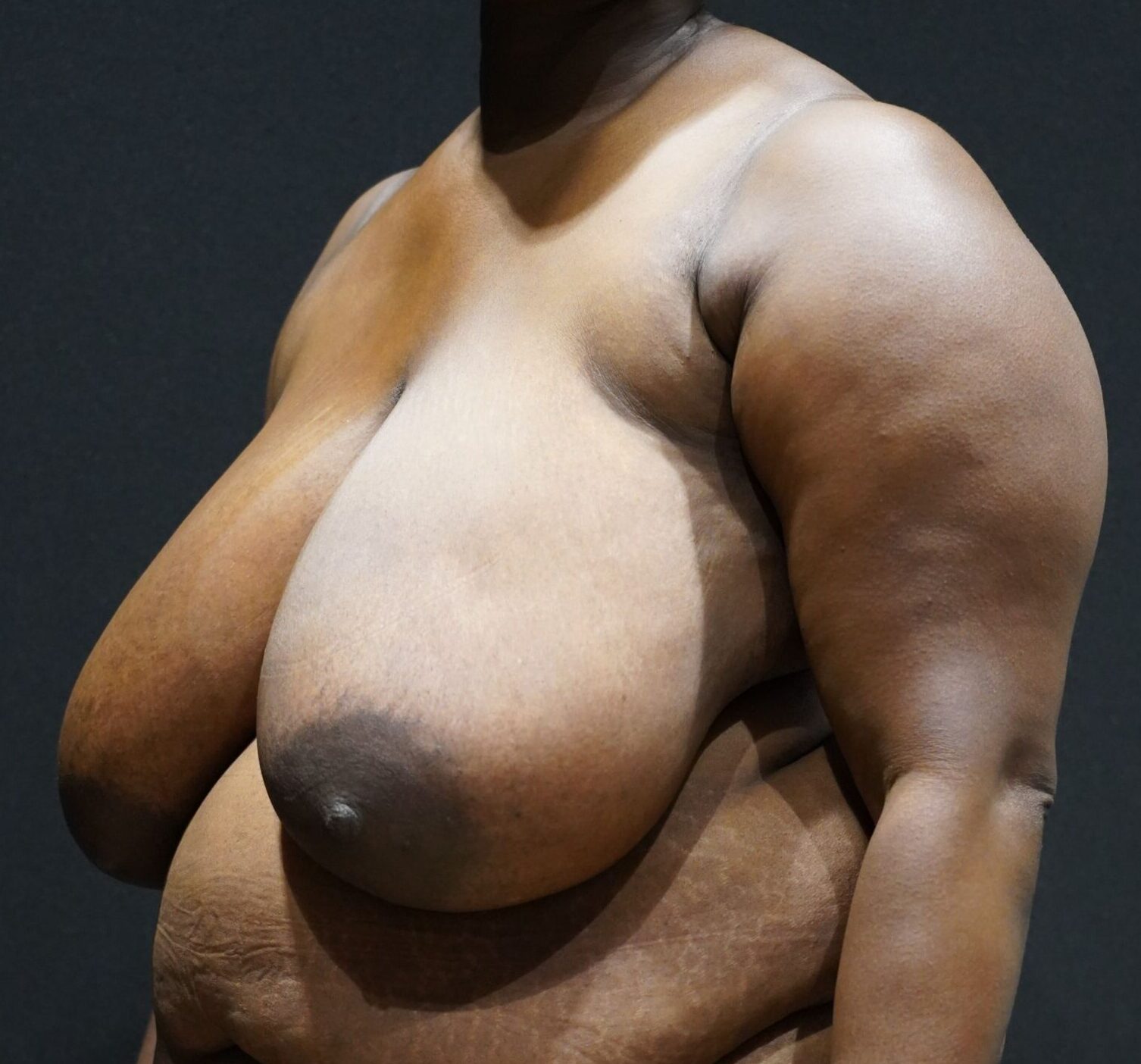 Before photo - -45° view