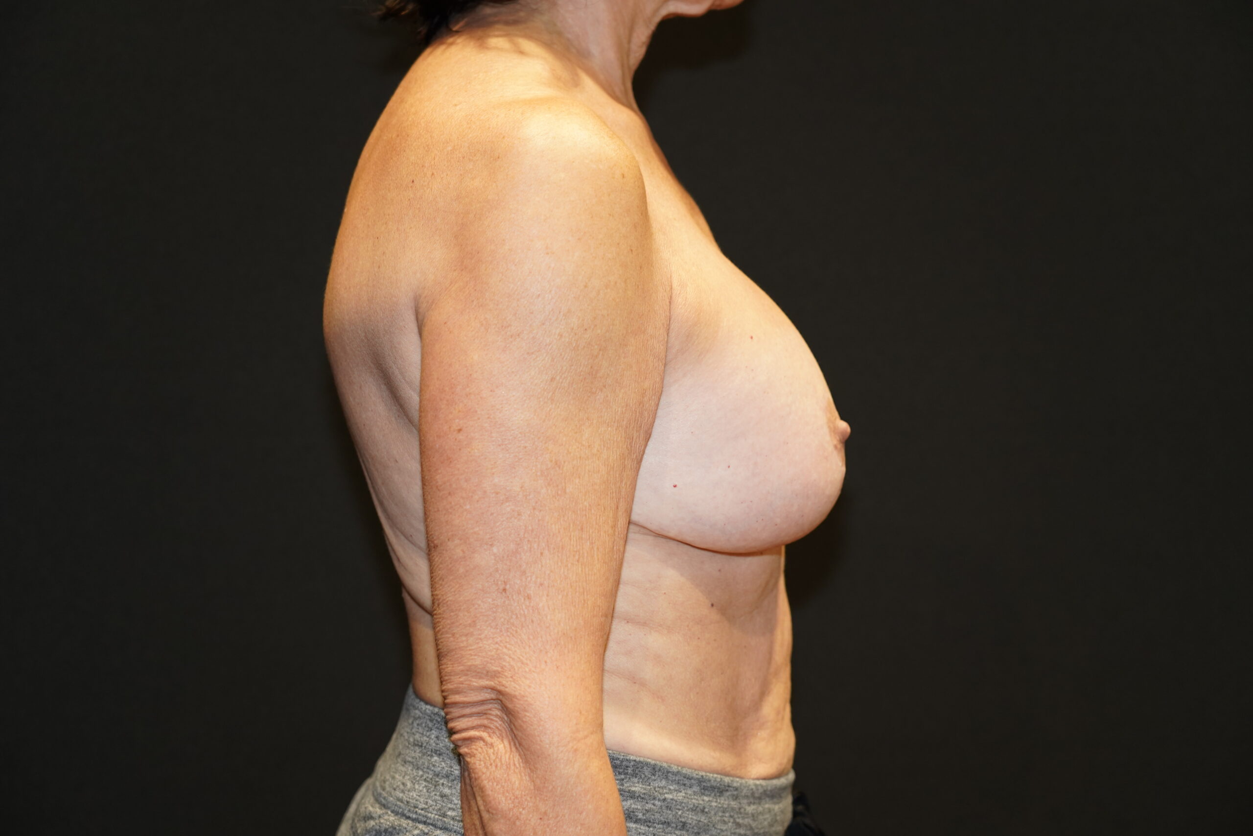 Case--2262 | After Breast Lift with Augmentation 5