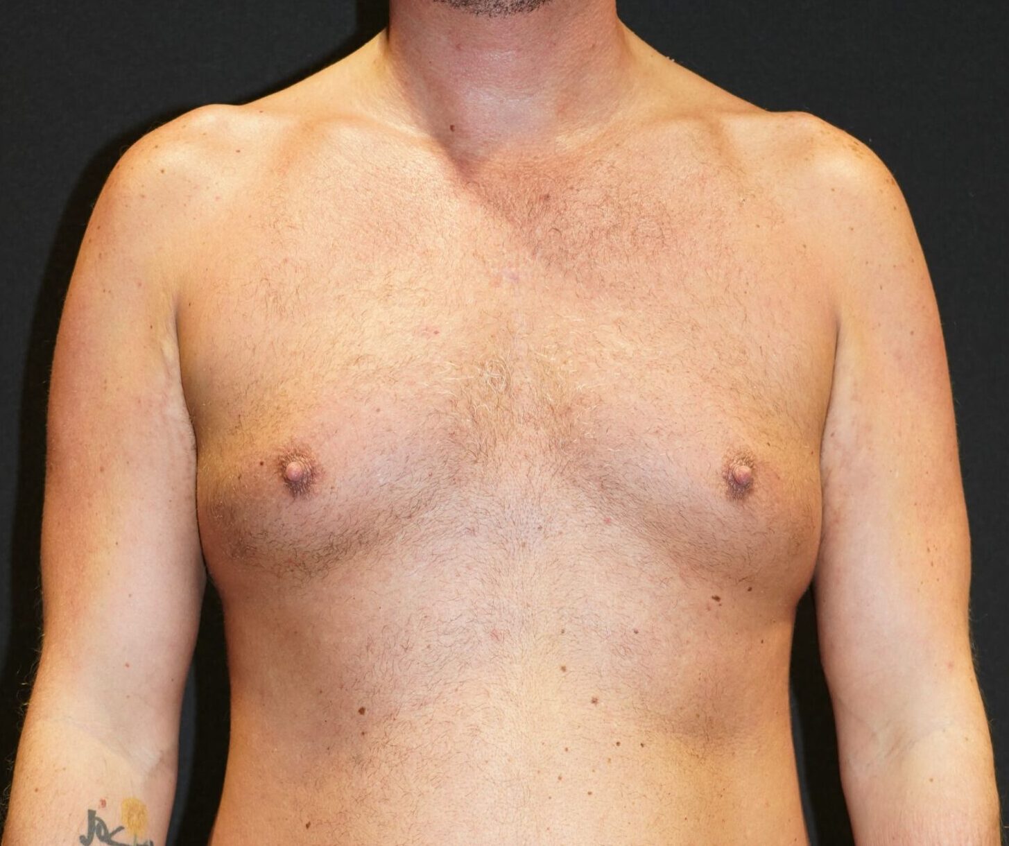 Before photo - 0° view