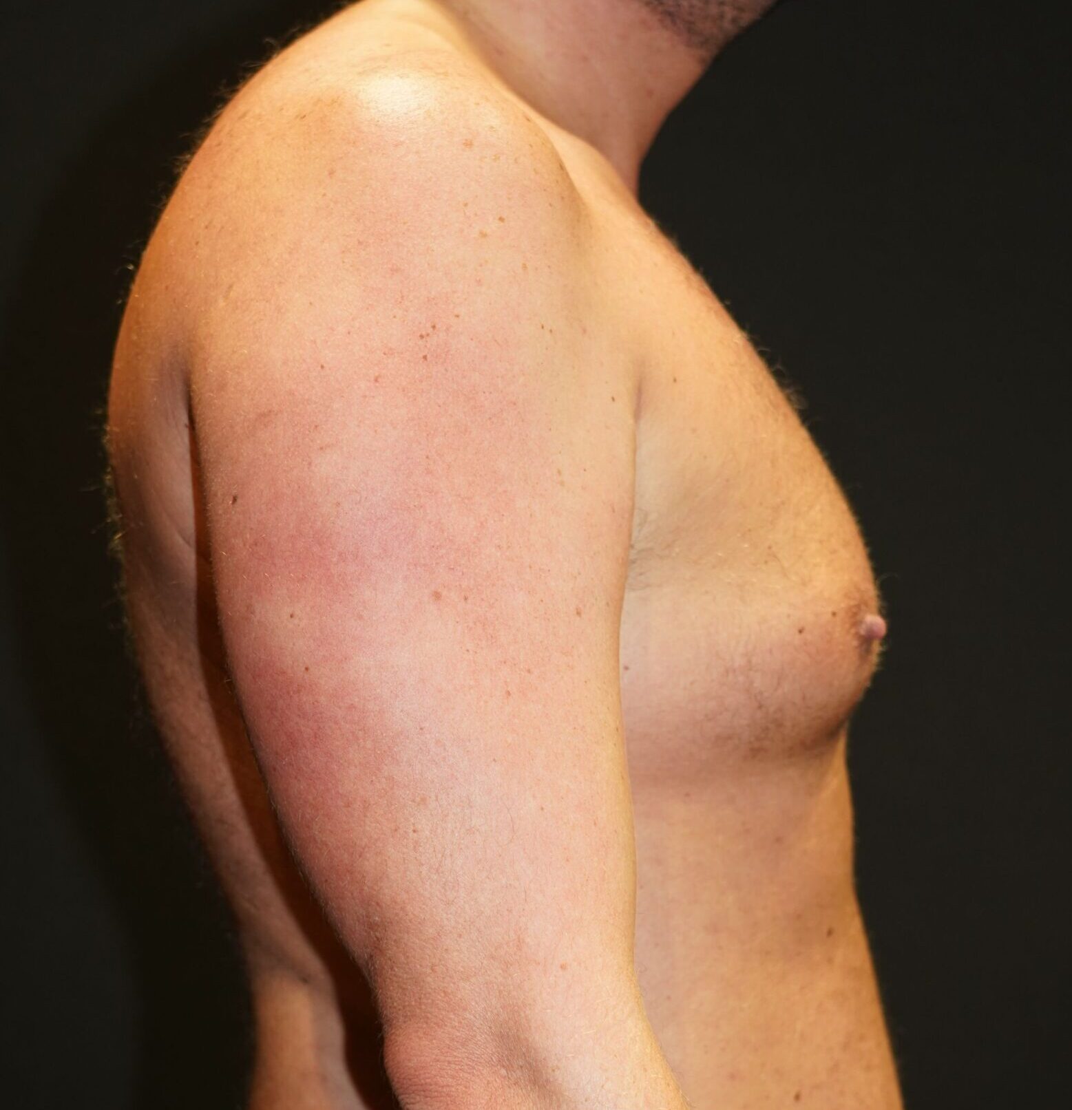 Before photo - 90° view