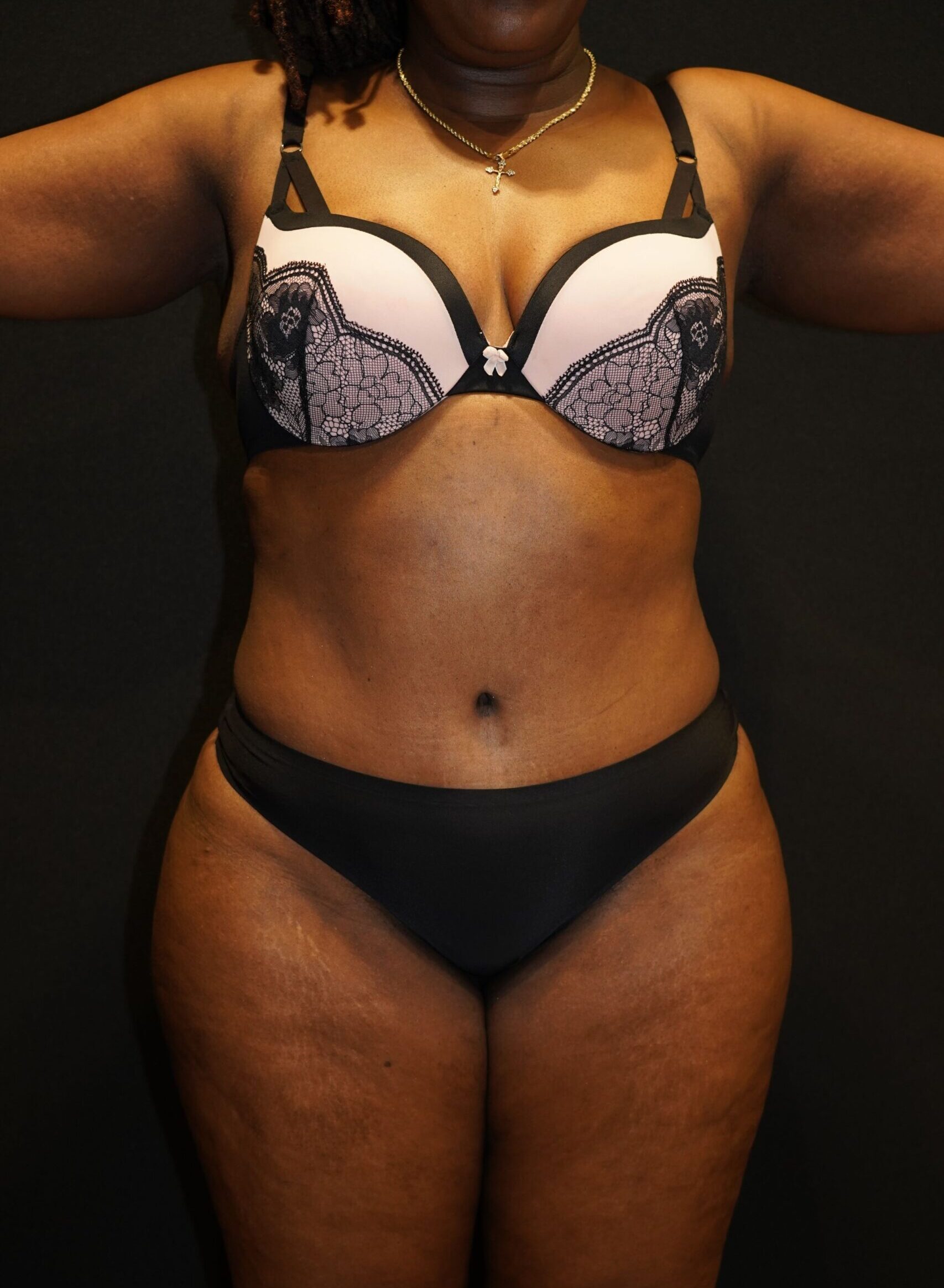 After photo - 0° view