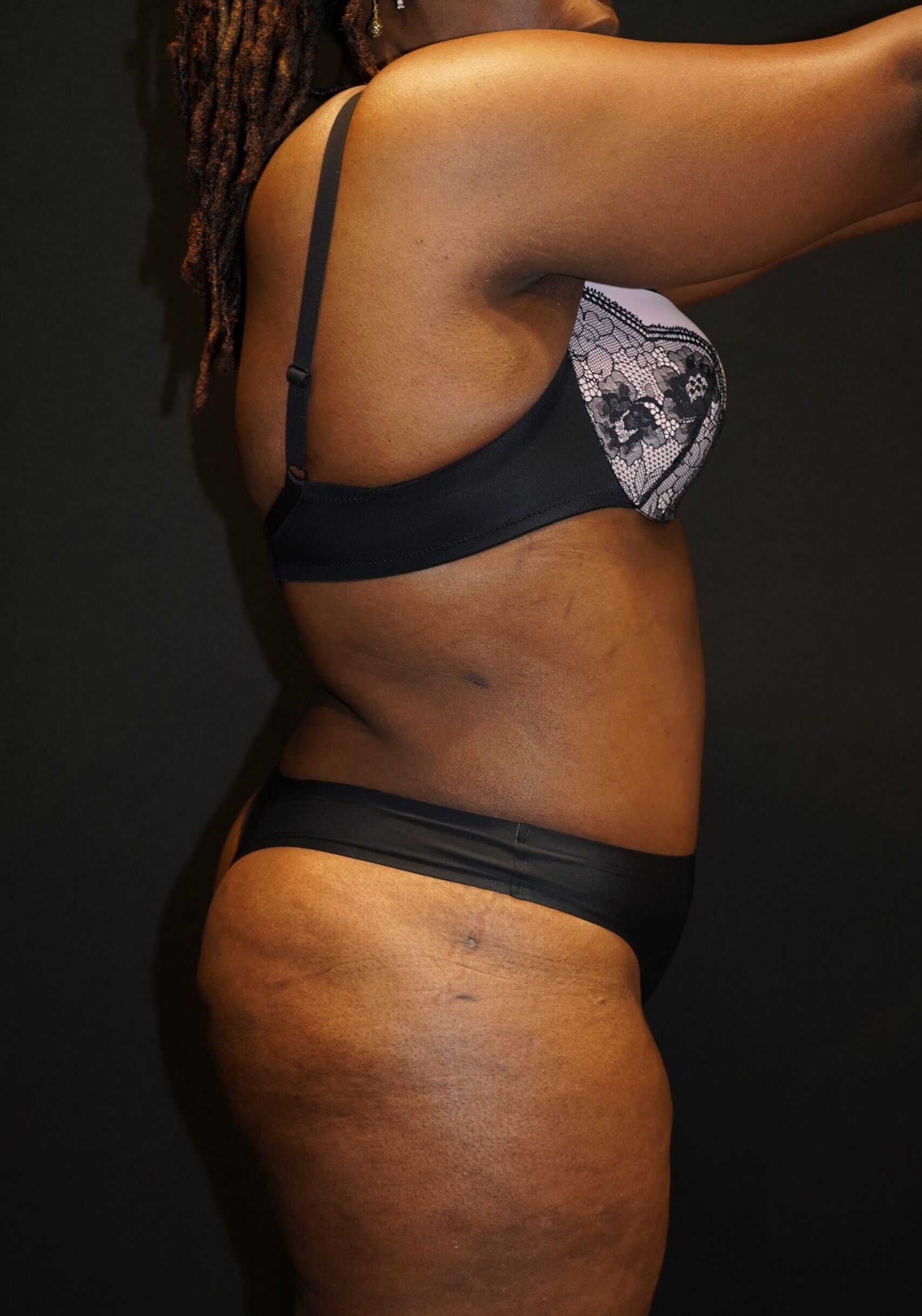 After photo - 90° view