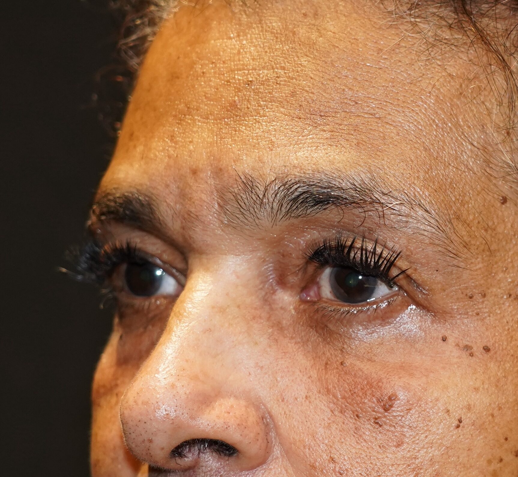 After photo - -45° view