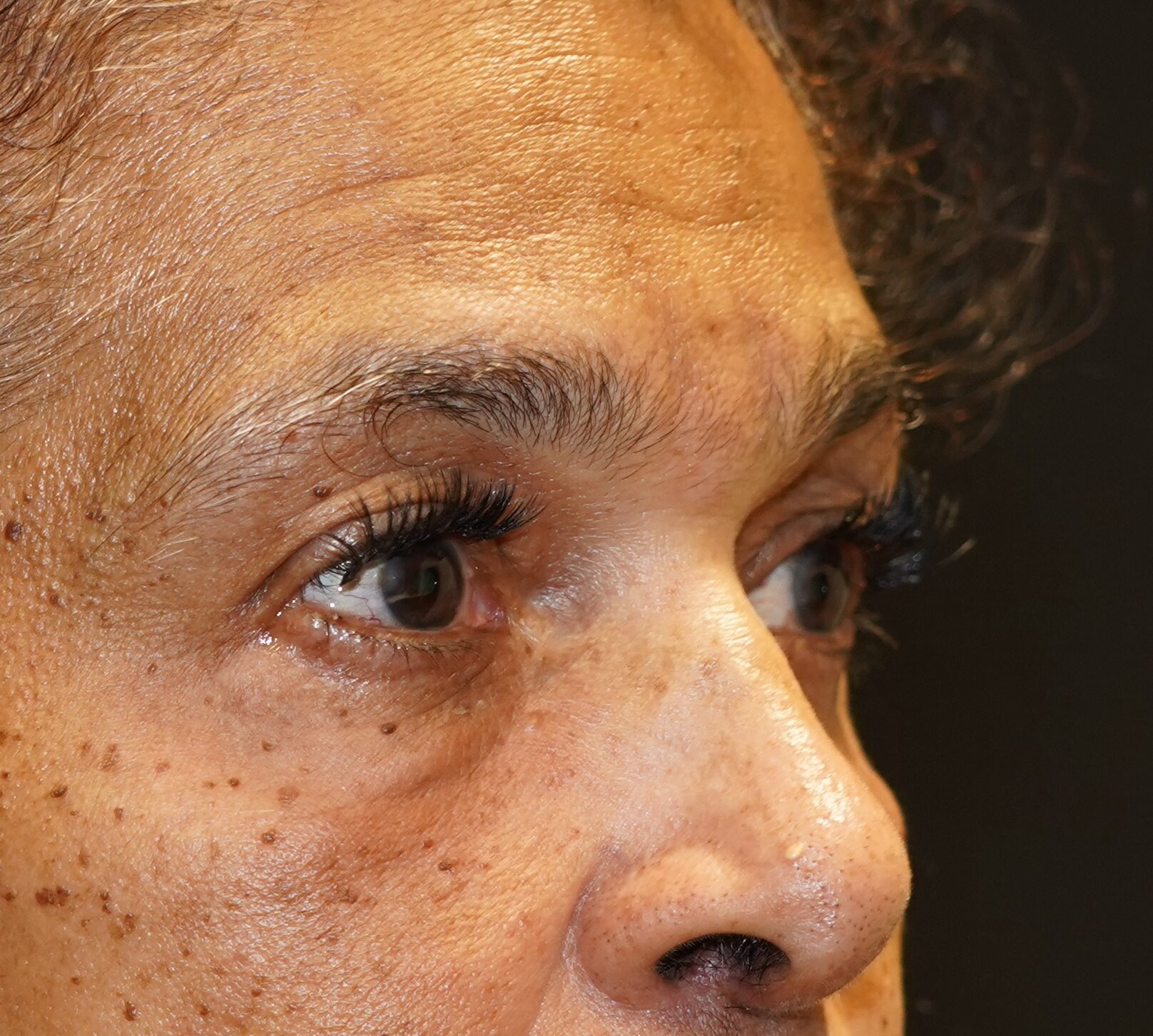 After photo - 45° view