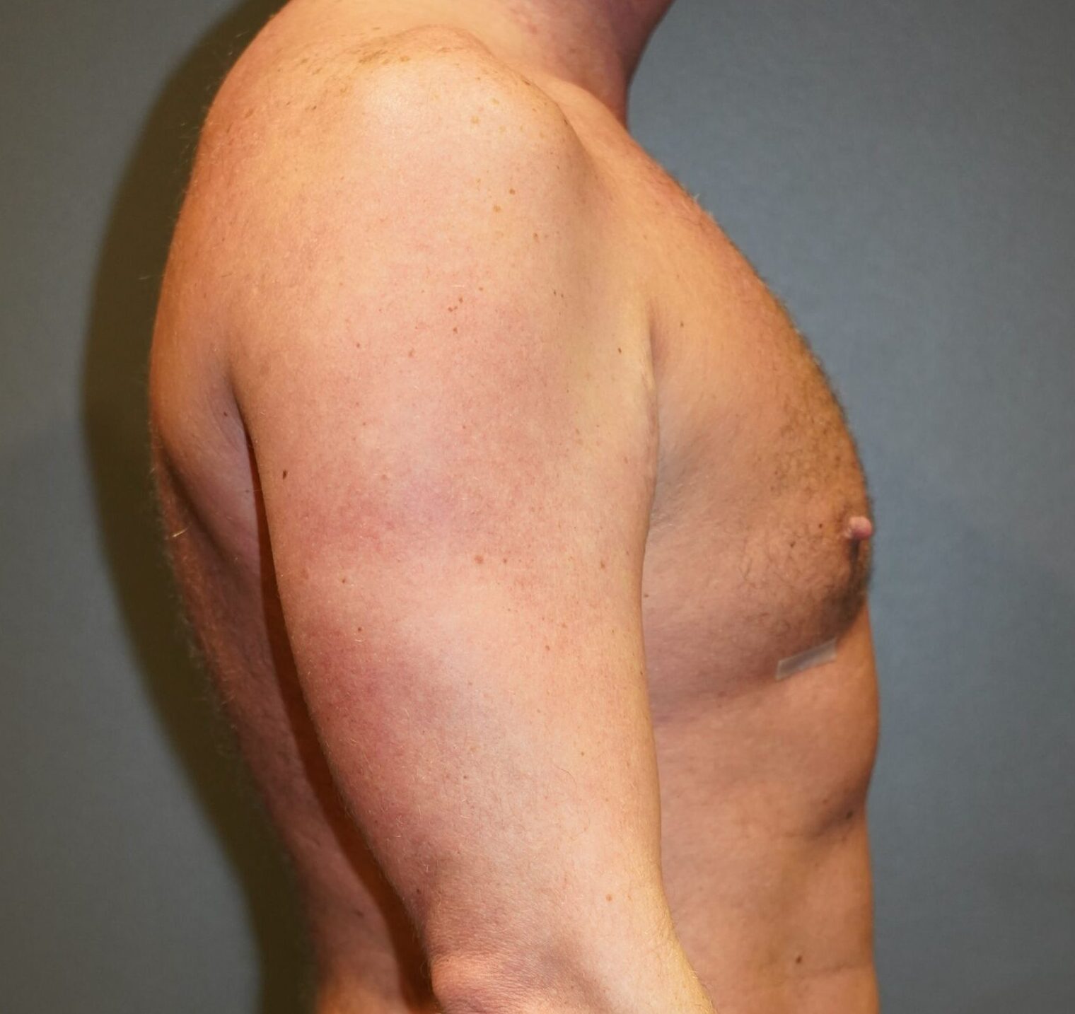 After photo - 90° view