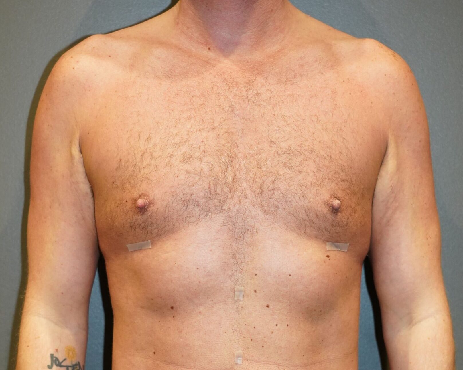 After photo - 0° view