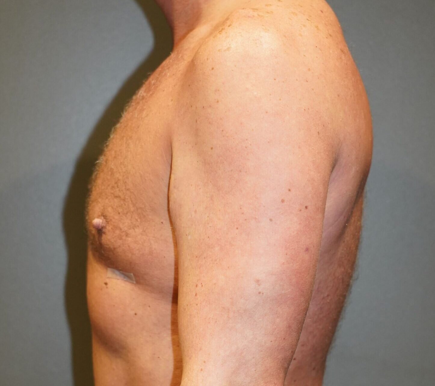 After photo - -90° view