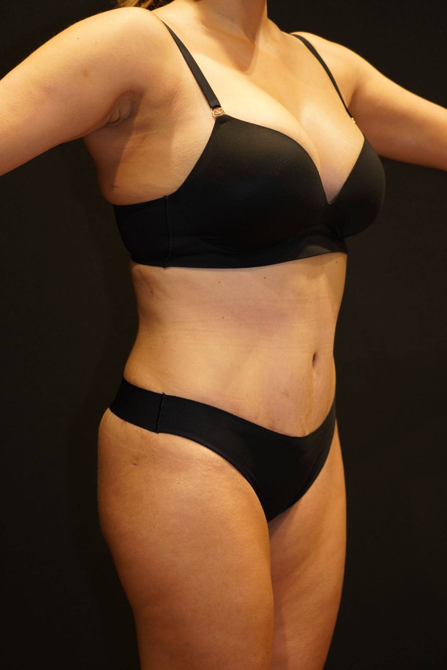 After photo - 45° view