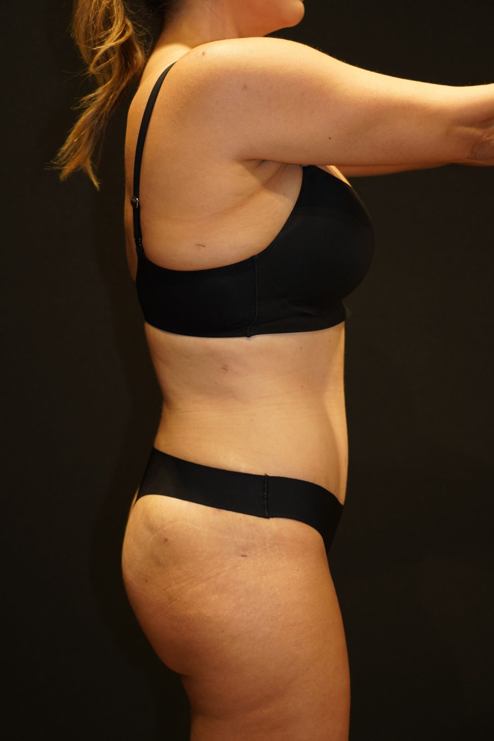 After photo - 90° view