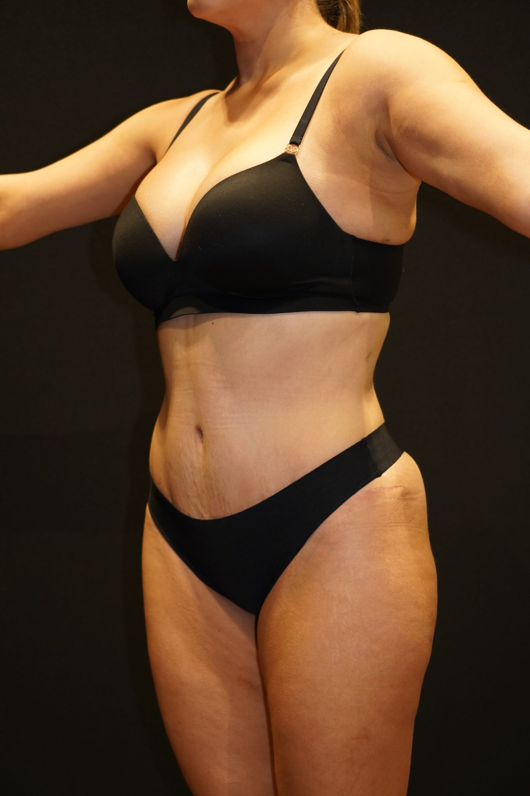 After photo - -45° view