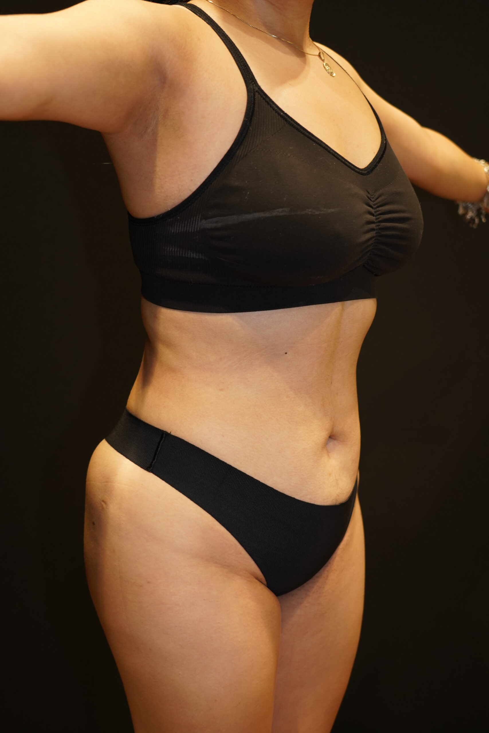Case--6194 | After Body Liposuction & Contouring 5