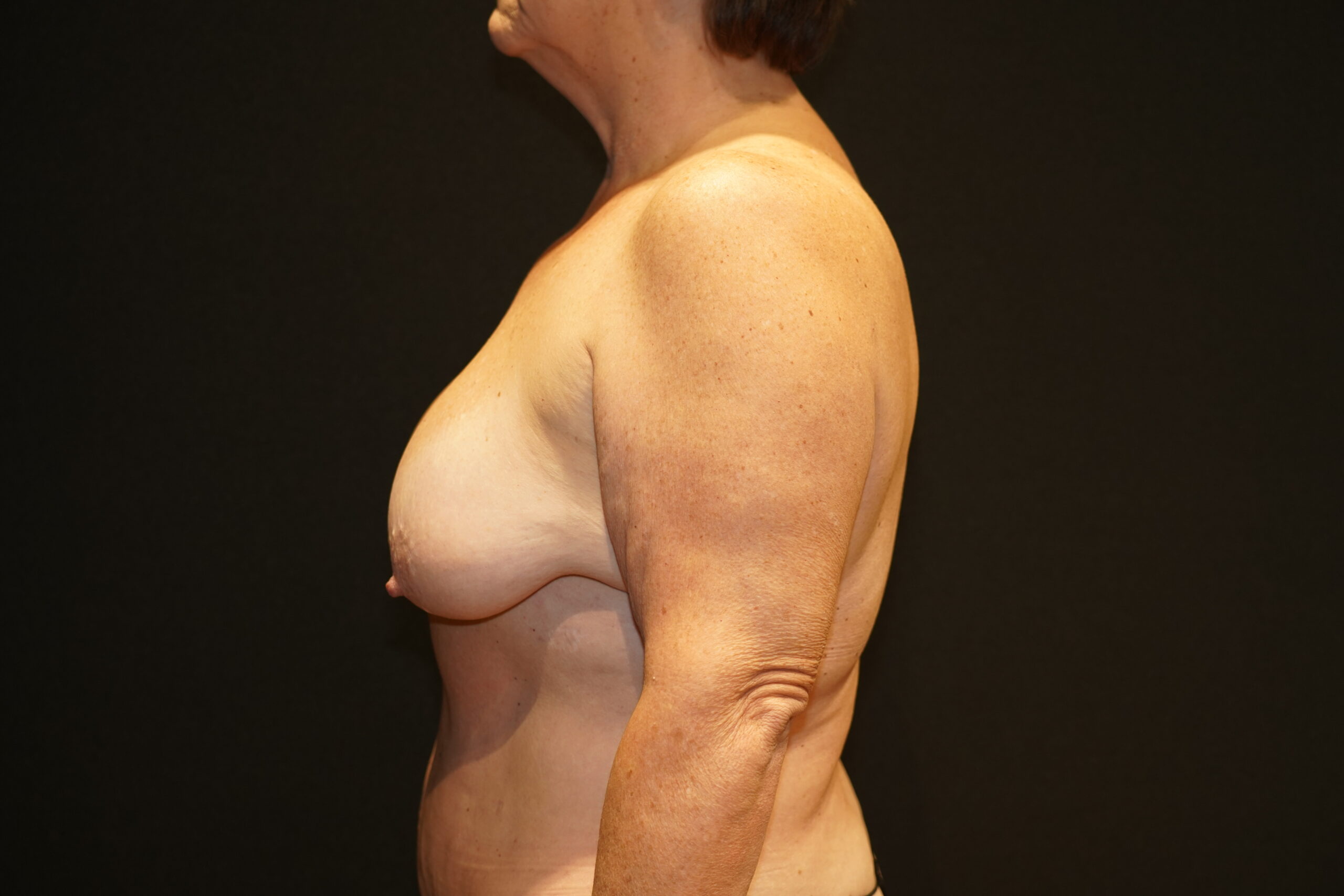 Case--6452 | Before Breast Lift/Mastopexy 4