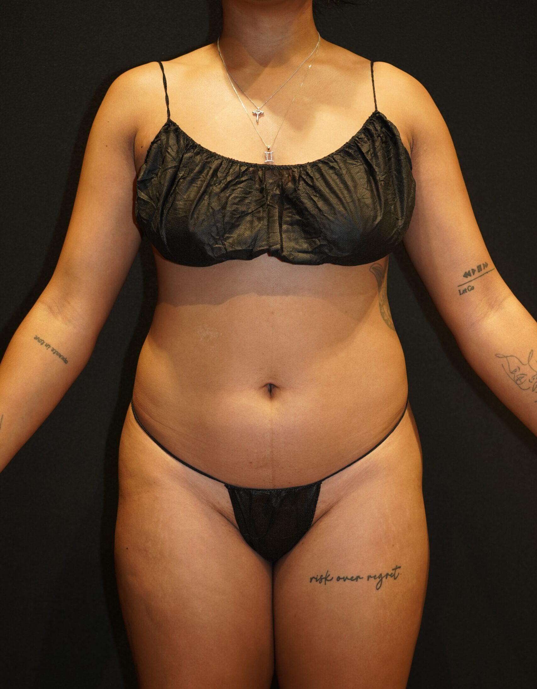 Before photo - 0° view