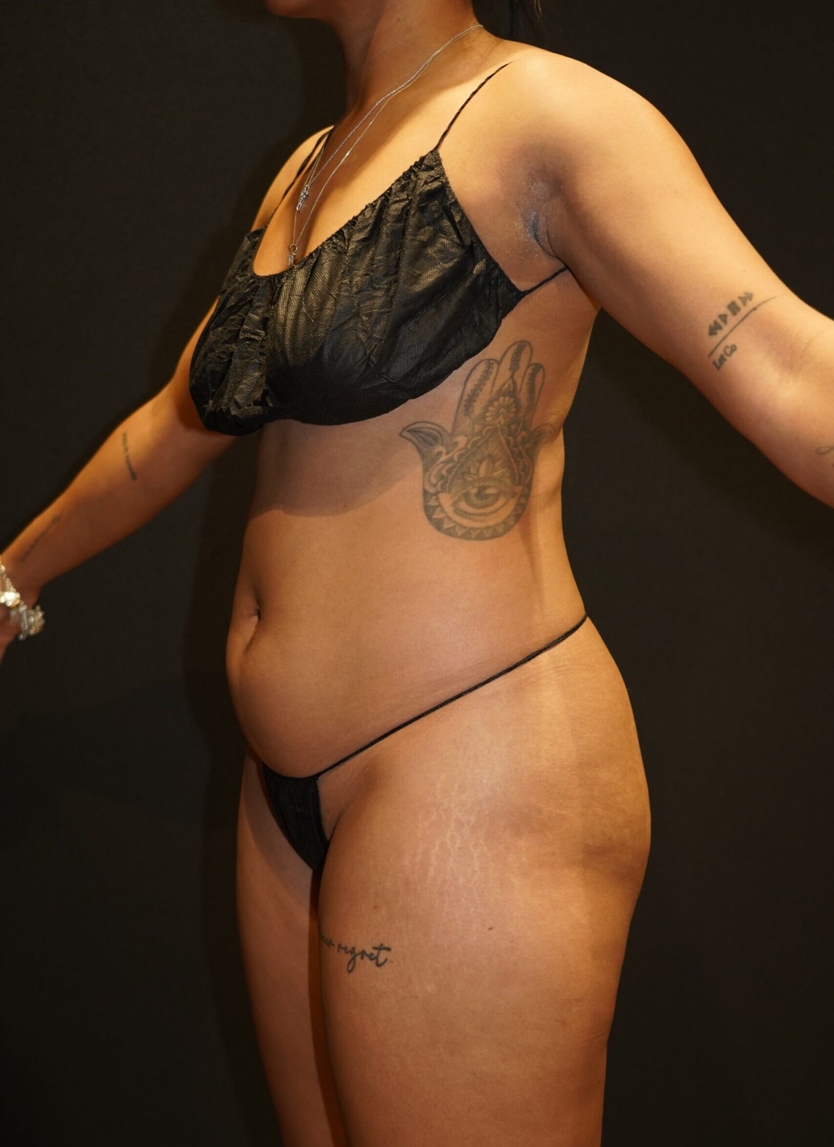 Before photo - 45° view