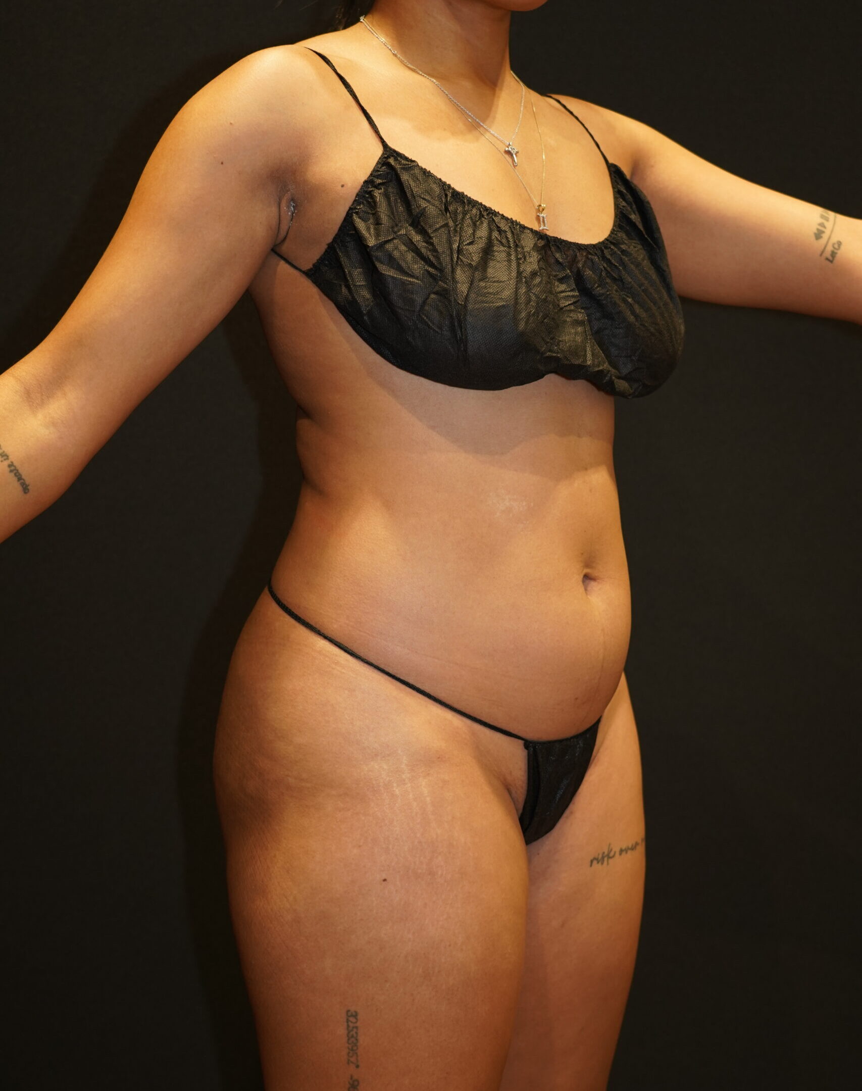 Before photo - -45° view