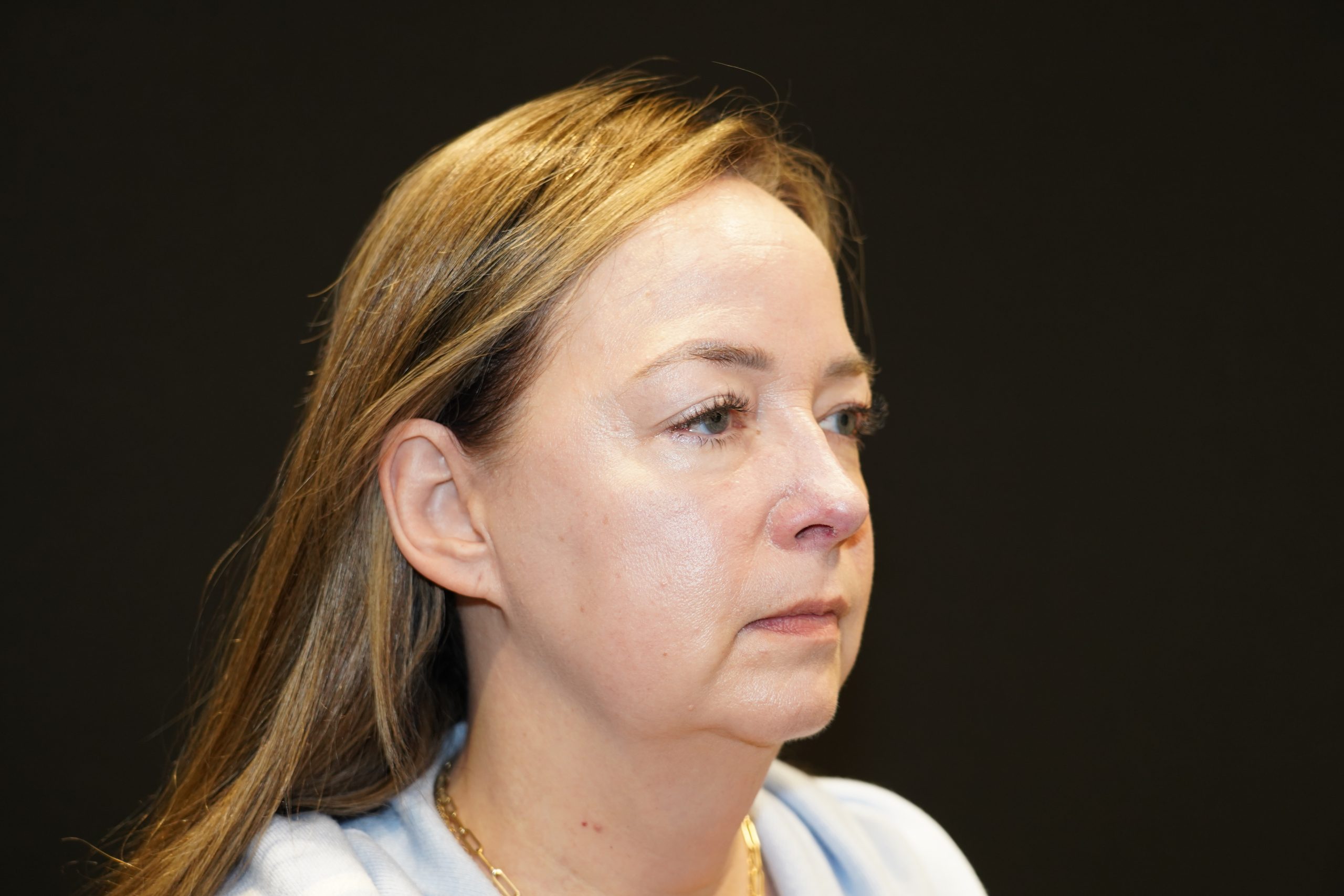 Case--3314 | Before Face Procedures