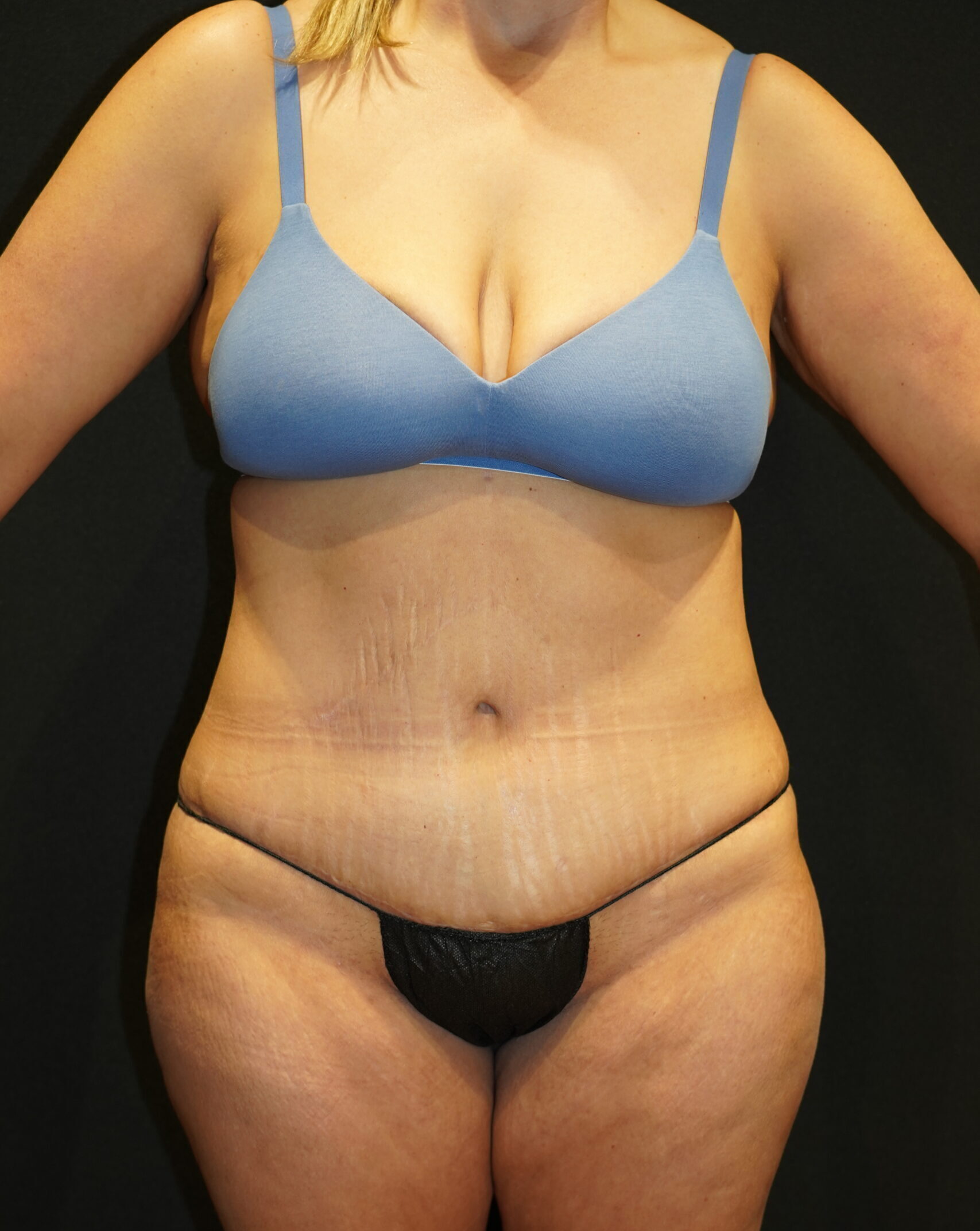 After photo - 0° view