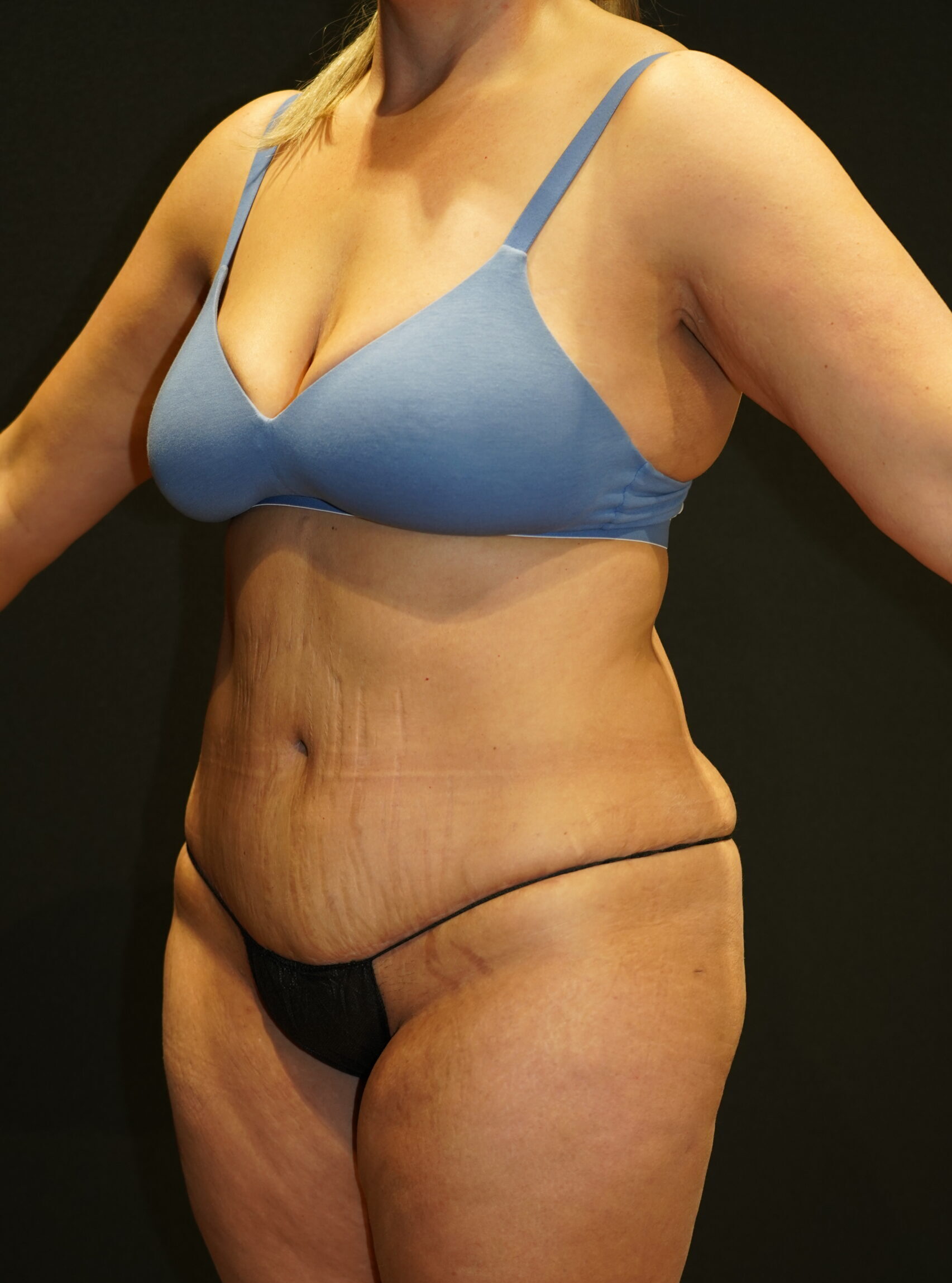 After photo - -45° view