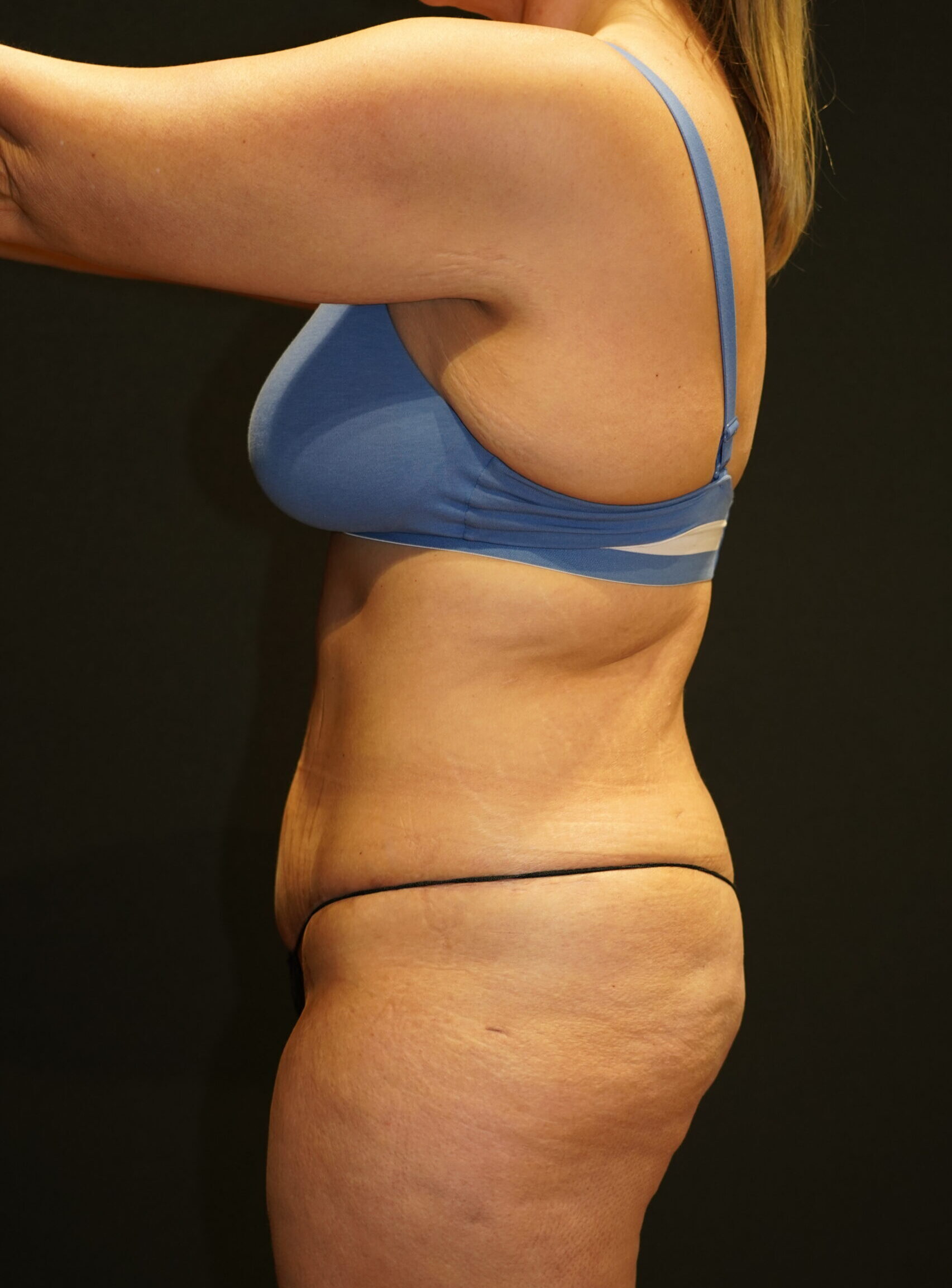 After photo - -90° view