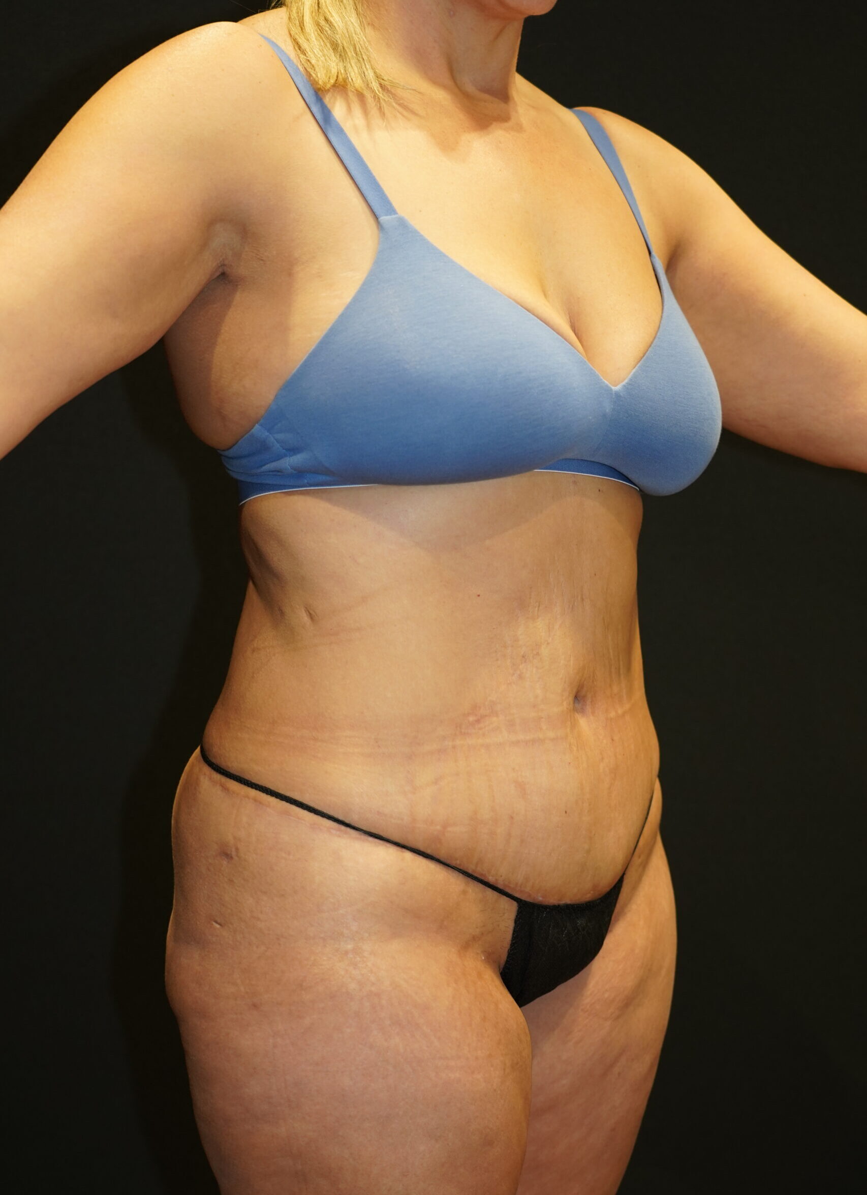 After photo - 45° view