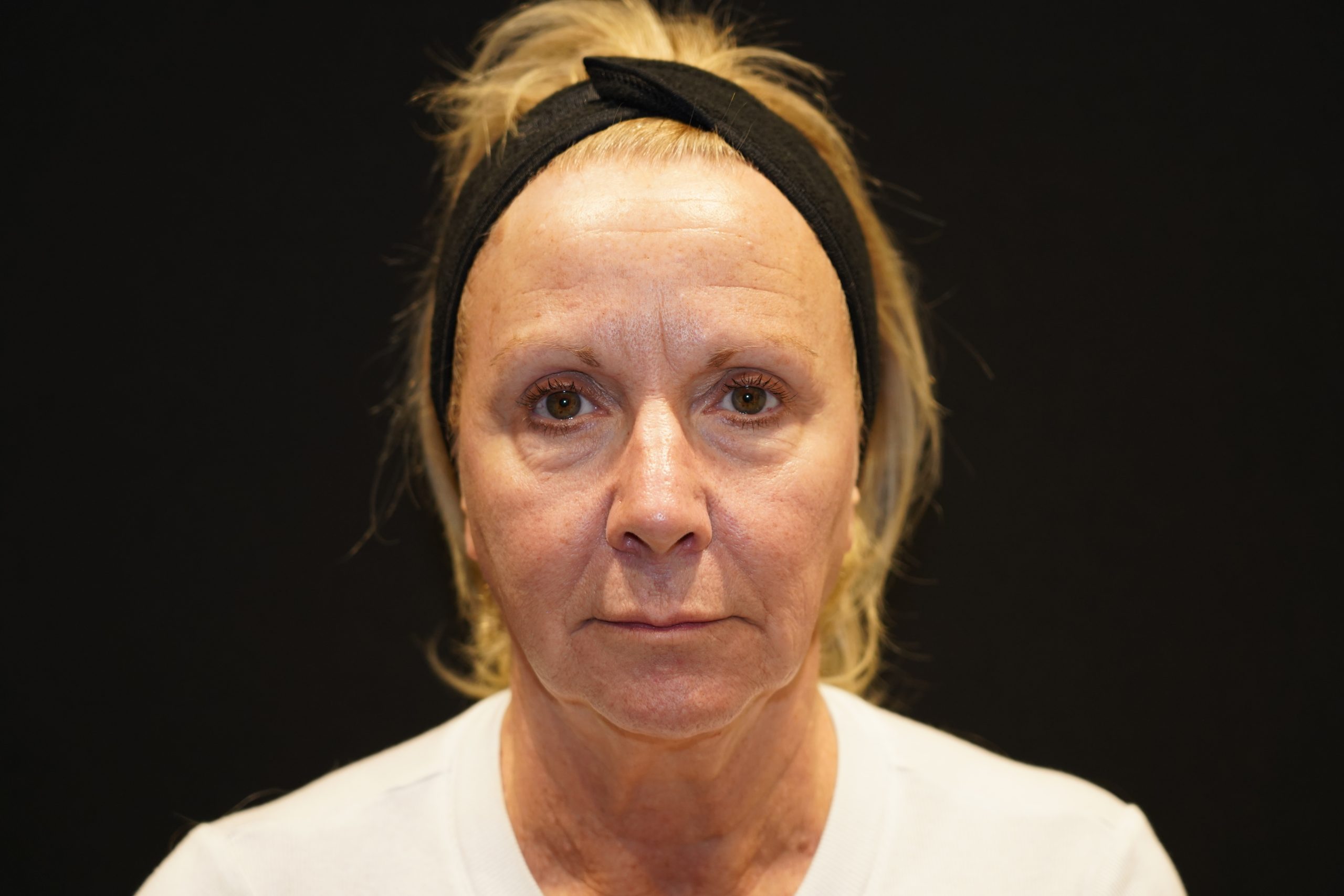 Case--3243 | Before Face Procedures