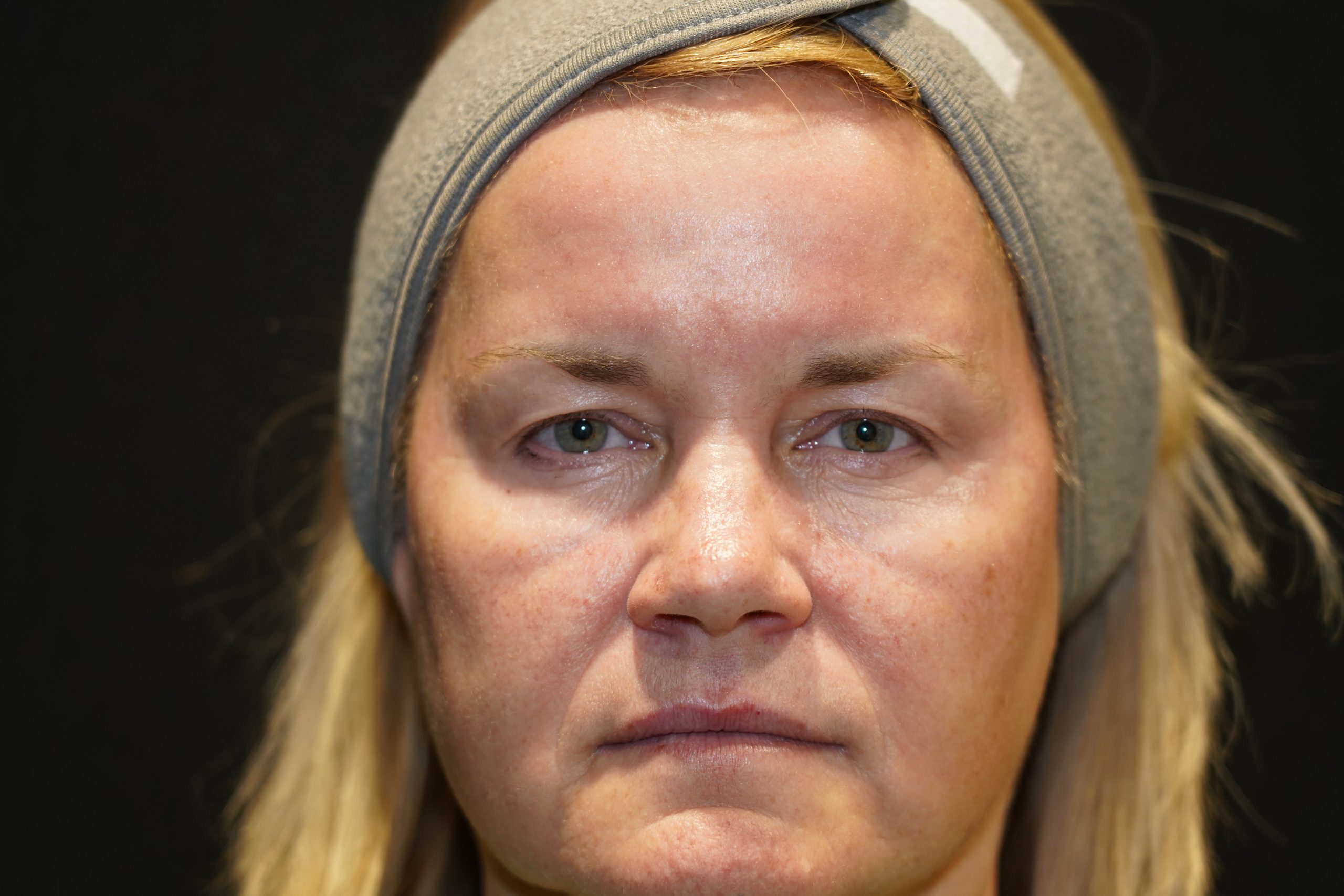 Case--5684 | Before Face Procedures