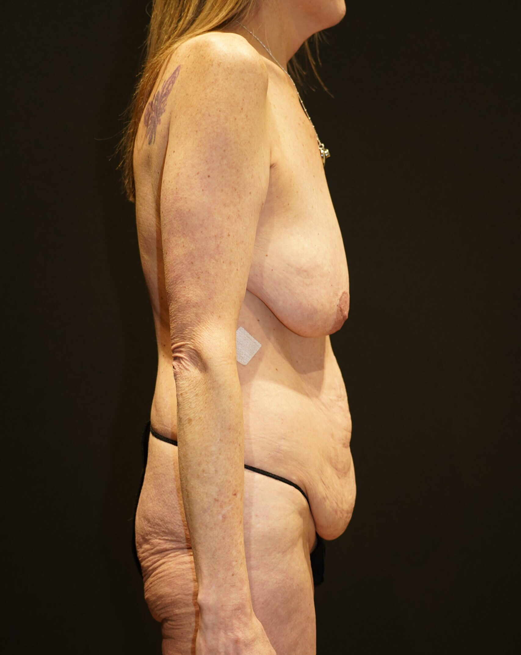 Before photo - 90° view