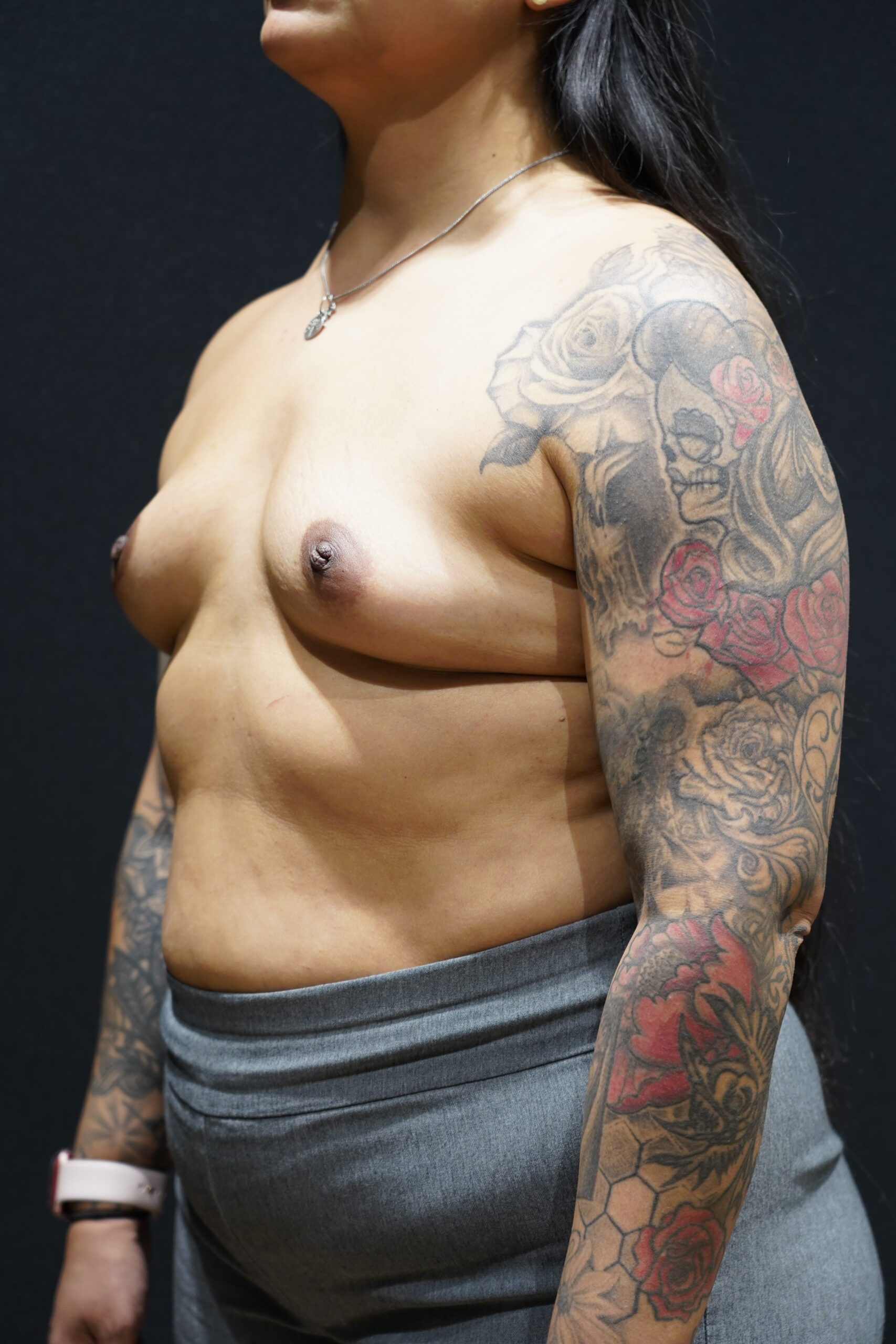 Case--7240 | Before Breast Augmentation 2