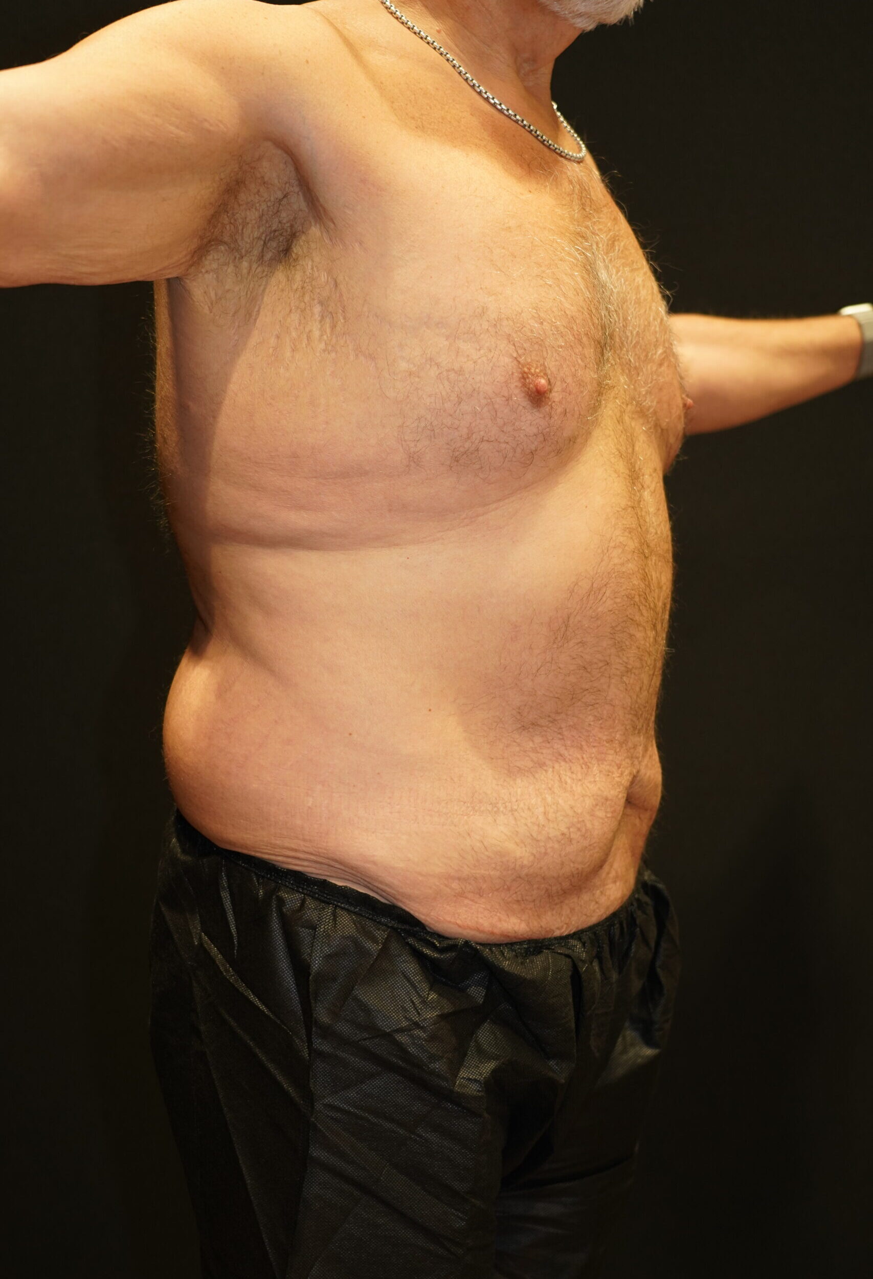 Before photo - -45° view