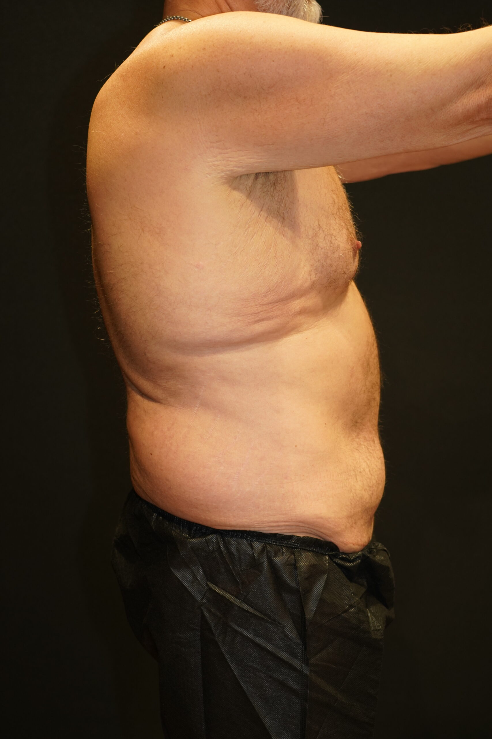 Before photo - -90° view