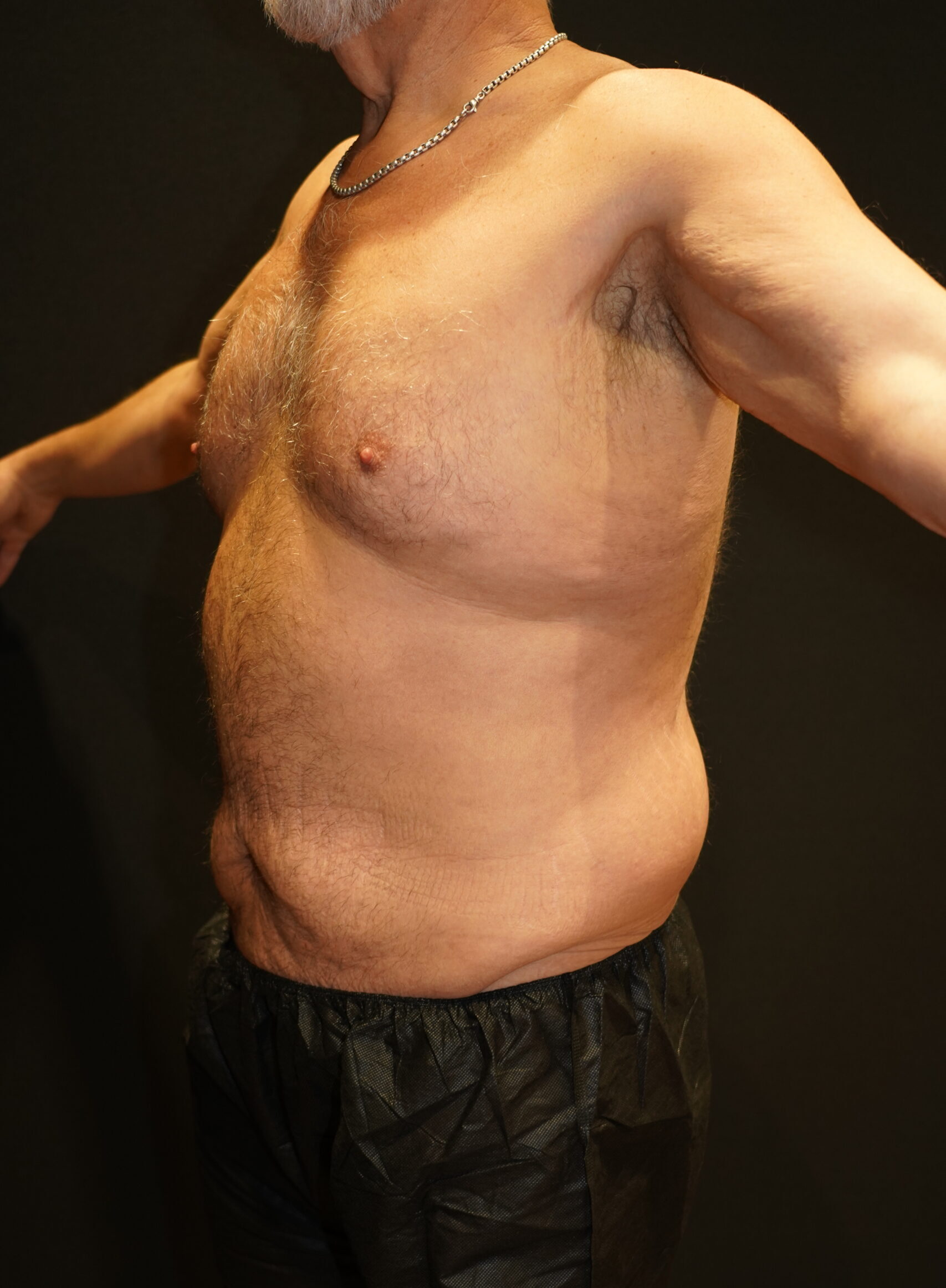 Before photo - 45° view