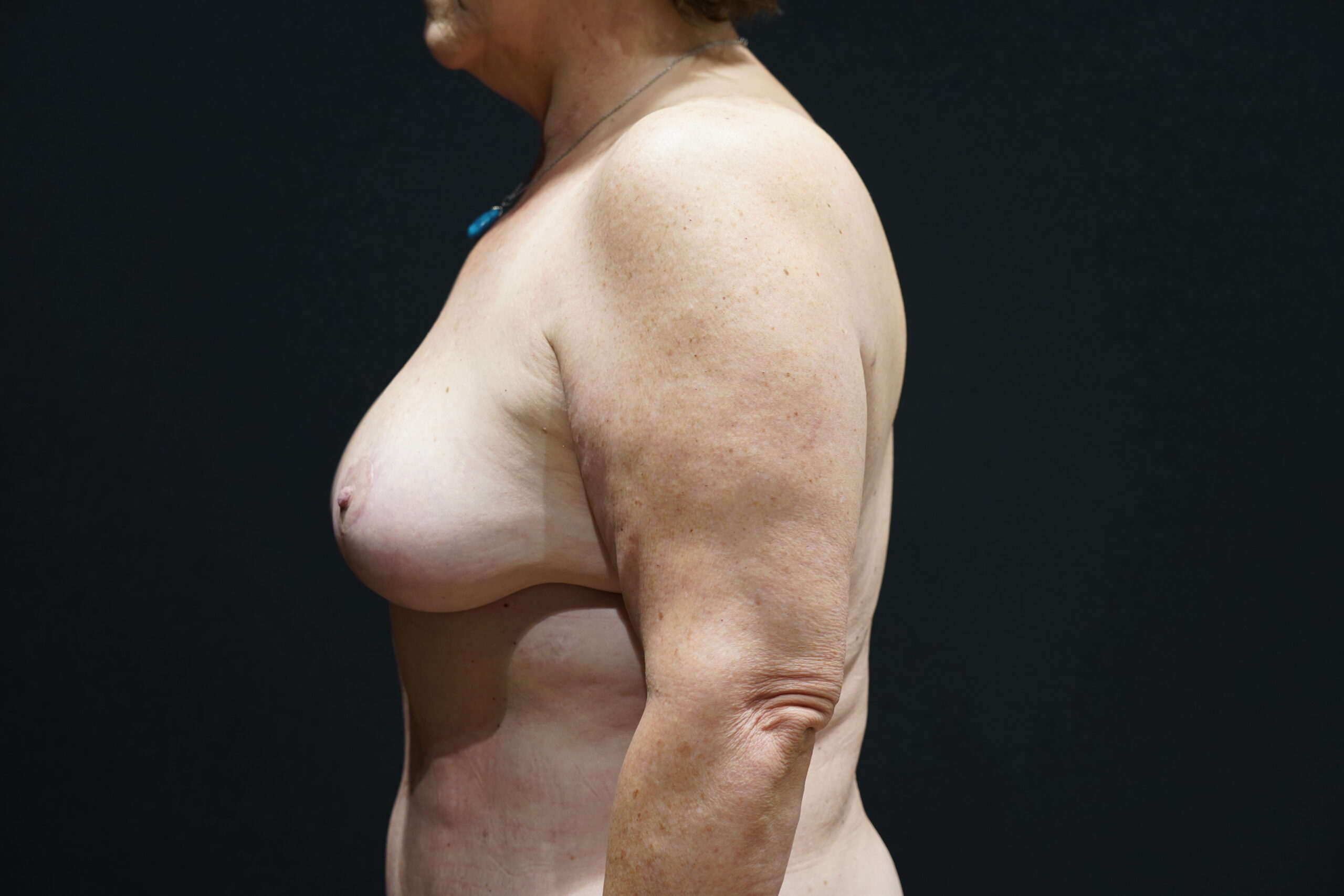 Case--6452 | After Breast Lift/Mastopexy 4
