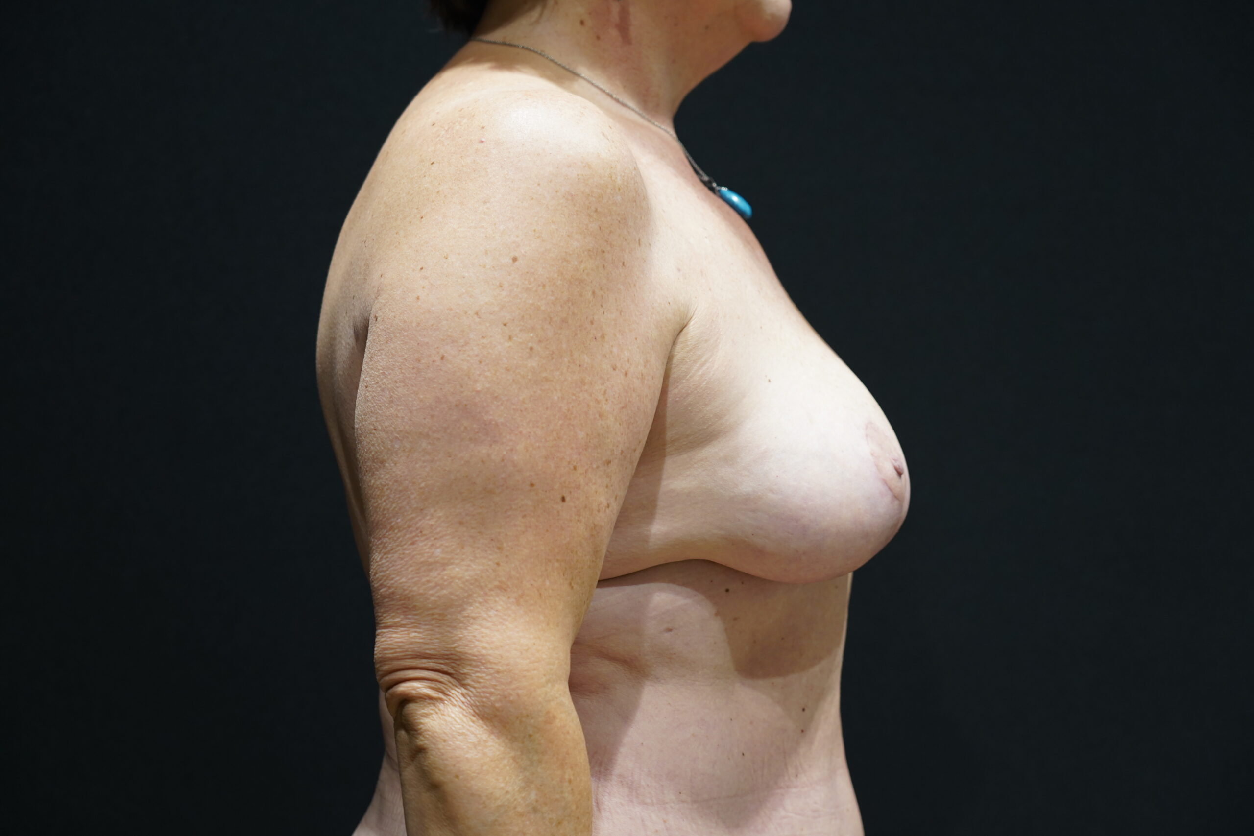 Case--6452 | After Breast Lift/Mastopexy 1